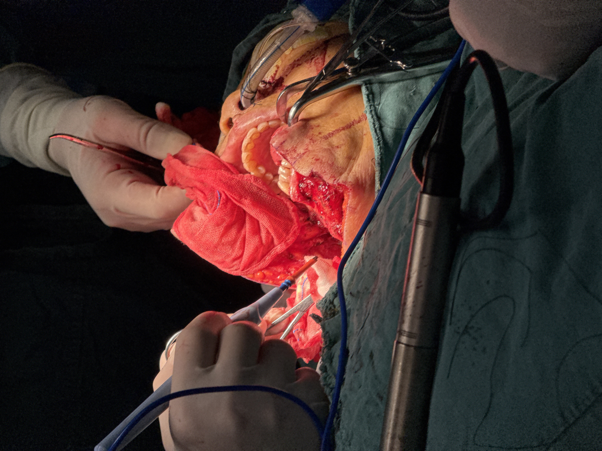 A surgical procedure is in progress. A patient is on an operating table, face visible, with surgical tools in their mouth and around the surgical site. One surgeon, wearing surgical gloves, is holding instruments and operating on the patient. A second surgeon can be seen adjacent to the first. There is a red surgical towel. The environment is a dark operating room. There is no information to identify Yuzhong District, China in this image.