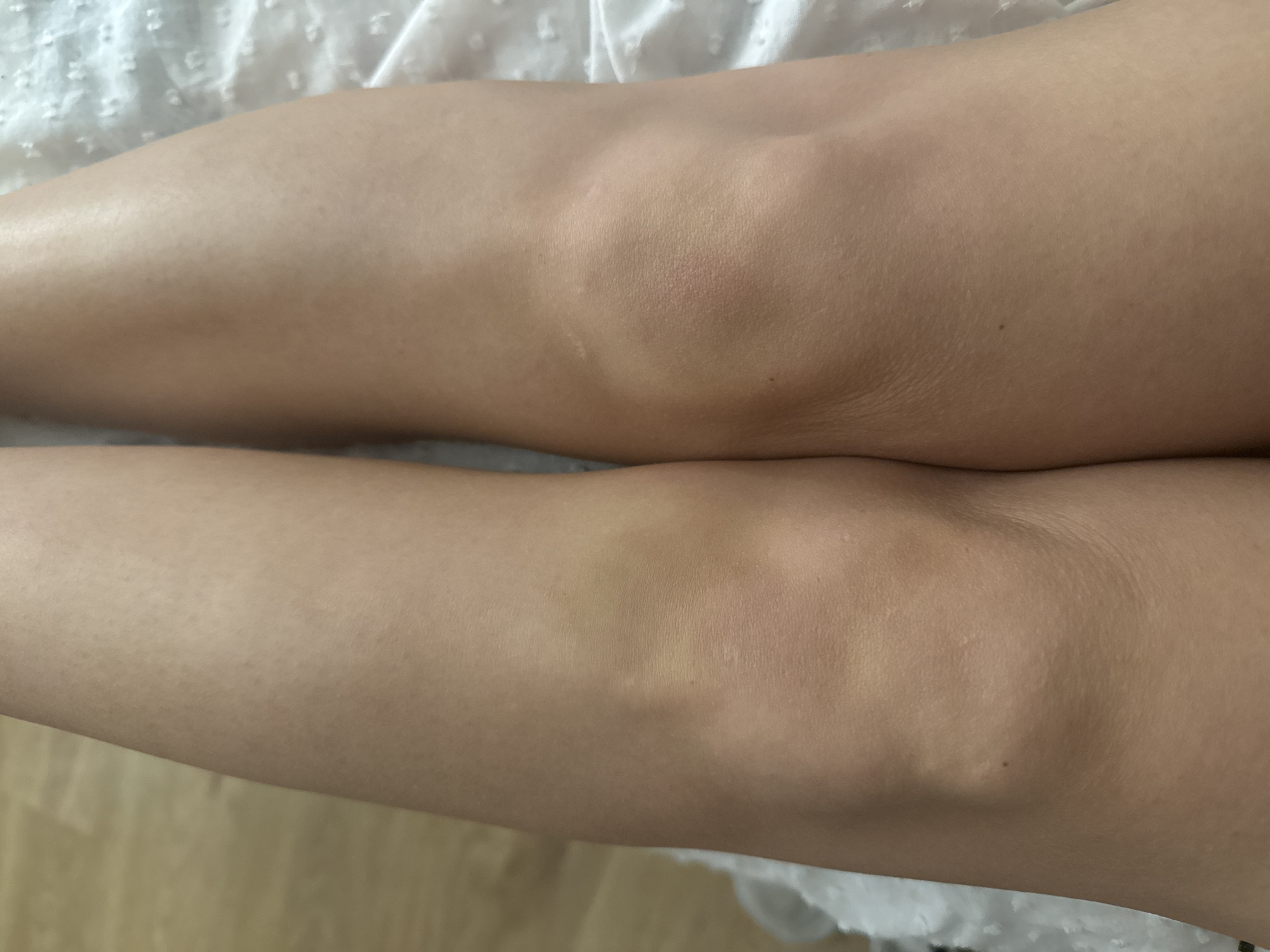 A top-down view captures the lower thighs and knees of an individual. The skin exhibits a light-to-medium complexion with visible follicular pores. The left knee area presents a diffuse, pale yellowish discoloration on the inner aspect, and a small, dark nevus is visible superior and medial to the patella. The right knee displays slight erythema (redness) and several faint, linear excoriations on its surface. The immediate environment includes a light-colored wooden surface positioned to the left of the legs and a white, textured fabric, possibly a bedsheet with raised dots, to the right. The individual's body position suggests they are at rest. The scene is located in Batumi, Georgia.