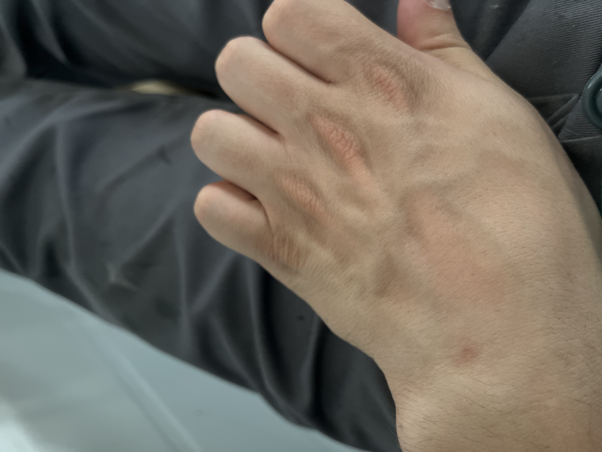 The image shows a close-up view of a person's hand resting on dark gray fabric, likely pants. The hand is pale with visible veins and some light reddish discoloration on the knuckles. There is a small reddish mark on the skin near the wrist. The background is out of focus, showing a lighter colored surface to the left and the continuation of the dark gray fabric. No specific location in Kyiv, Ukraine, can be identified from this image.