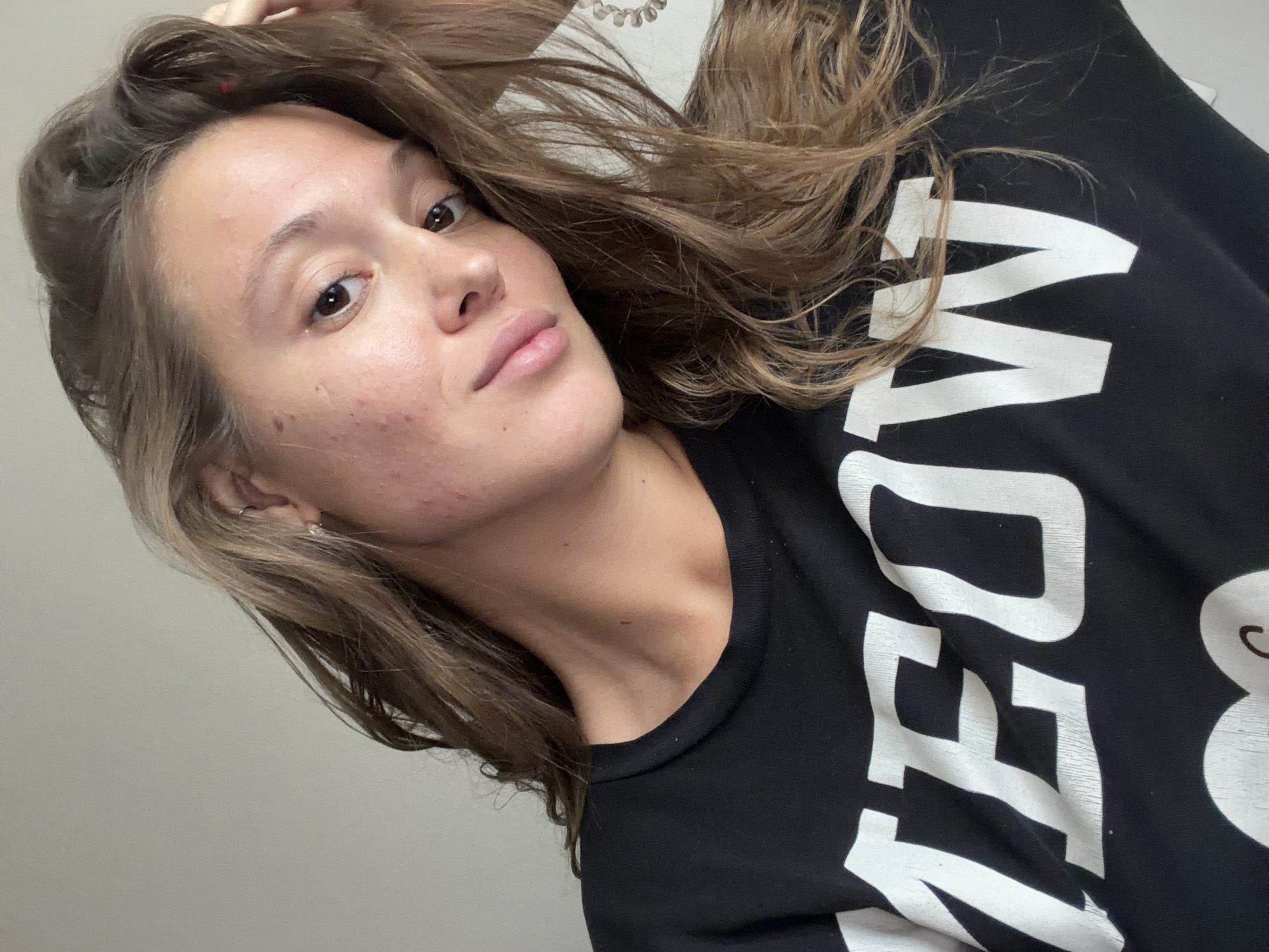 A woman with light brown hair is facing the camera. She has visible acne scars on her face. She is wearing a black shirt with white lettering. The background is a plain wall. It is not possible to determine the location in the city of Nakhodka, Russia from this image.