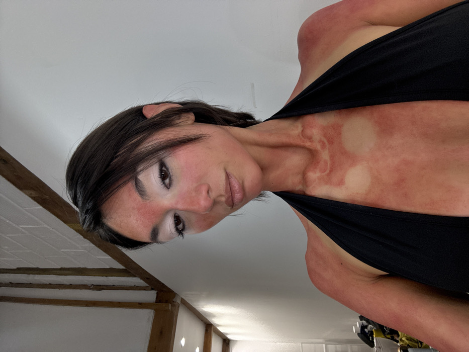 A female individual is photographed indoors, with a direct gaze towards the viewer. She exhibits widespread redness across her face, neck, chest, and shoulders, consistent with severe sunburn. Her facial skin, including the forehead, cheeks, and nose, is red, contrasting sharply with prominent white eyeshadow applied to her eyelids. Dark eyeliner defines her eyes. Her lips are a natural, light shade. Her short, dark hair frames her face with bangs. On her chest, two distinct circular areas of unburned skin are visible against the reddened background, along with irregular patterns of redness on her neck and collarbone area. Tan lines are also present on her shoulders, indicating areas protected from sun exposure. She wears a black halter-neck top. The background consists of plain white walls and exposed light-colored wooden beams on the upper right, with recessed lighting visible on a white surface in the upper left. No specific architectural features or external identifiers are present to definitively confirm the location within Paris, France; the setting appears to be a minimalist studio or modern interior space.