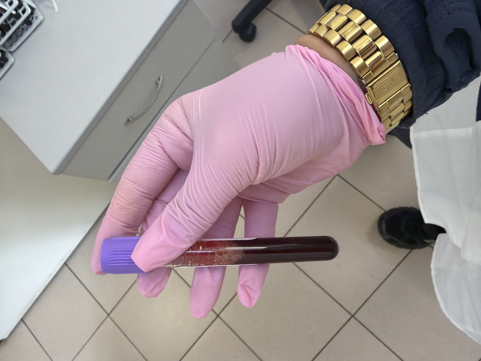 An overhead shot captures a gloved hand holding a blood sample tube in what appears to be a medical or laboratory setting in Sofia, Bulgaria. The central subject is a person's hand, covered by a pink medical examination glove. This hand firmly holds a clear glass or plastic vacutainer tube filled with a dark red liquid, indicative of a blood sample. The tube has a distinctive purple cap. Near the capped end, the blood sample shows a significant amount of white or light-colored foam or bubbles.
The person's forearm is partly visible, clothed in a dark blue long-sleeved garment, and adorned with a prominent gold-colored watch featuring a robust link bracelet. The clasp of the watch clearly displays the brand name "LOTUS."
In the background, a light gray cabinet or drawer unit with a curved silver handle is visible to the left. The floor is covered with light-colored square tiles, suggesting a clean, institutional environment. Partially visible on the right are parts of a white lab coat or uniform and a black shoe, further reinforcing the medical or scientific context of the scene. The image focuses closely on the hand and the blood tube, with the background providing contextual cues about the professional environment. No specific time of day or emotional states are discernible.