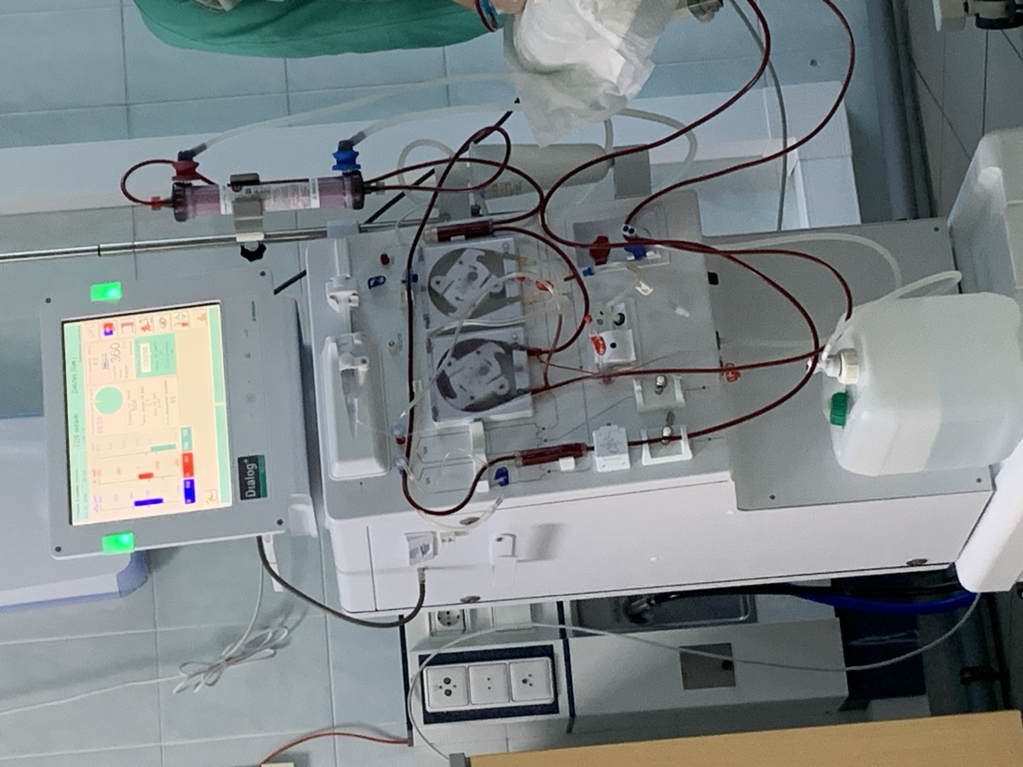 This media file captures a medical setup in what appears to be a clinical room in Chaikovsky, Russia. The main subject is a modern, white medical machine, strongly indicative of a hemodialysis or blood purification system.
The machine features a prominent vertical touchscreen display on its left side, showing a graphical user interface with various real-time parameters, numerical readouts (e.g., "360" is visible), and colored bar graphs (green, red, blue). The word "Dialog" is visible on the frame of this screen. A bright green indicator light is illuminated to the left of the screen.
In the central section of the machine, two clear, circular components, likely dialyzers or filters, are visible. These are interconnected by a complex network of tubes; some are dark red, visibly containing blood, while others are clear. Various clamps, pumps, and connectors are integrated into the tubing system. A cylindrical filter with reddish fluid is positioned at the top left, and a clear plastic container with a green cap is situated on the right, also connected by tubes.
A person's arm and a white sterile drape are partially visible at the top of the image, suggesting the presence of a medical professional or a patient undergoing treatment. The setting appears to be a sterile environment, with light-colored, possibly tiled walls. Below the machine, a white triple power outlet with three-pin sockets is mounted on the wall. The overall scene depicts an active medical procedure involving blood circulation through the specialized equipment.