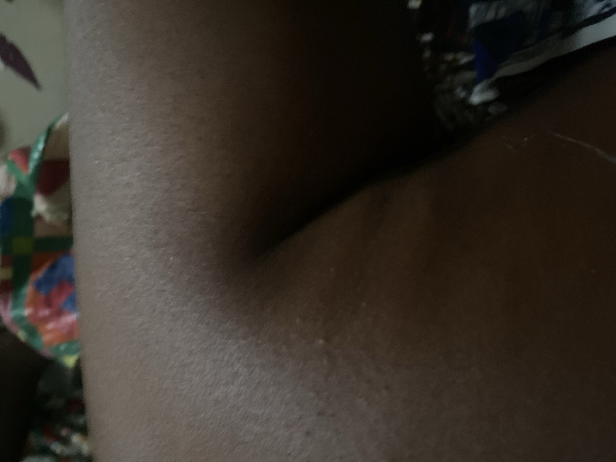 The image shows a close-up view of human skin, likely from a person's leg or thigh. The skin is dark-toned and appears to have a slightly textured surface. There are a few small, light-colored bumps visible on the skin. In the background, out of focus, is a colorful patterned fabric, possibly part of clothing or bedding. There is also a dark, shadowed area that obscures details in that part of the image. The setting is not identifiable as being specifically in Jauro Yinu, Nigeria.