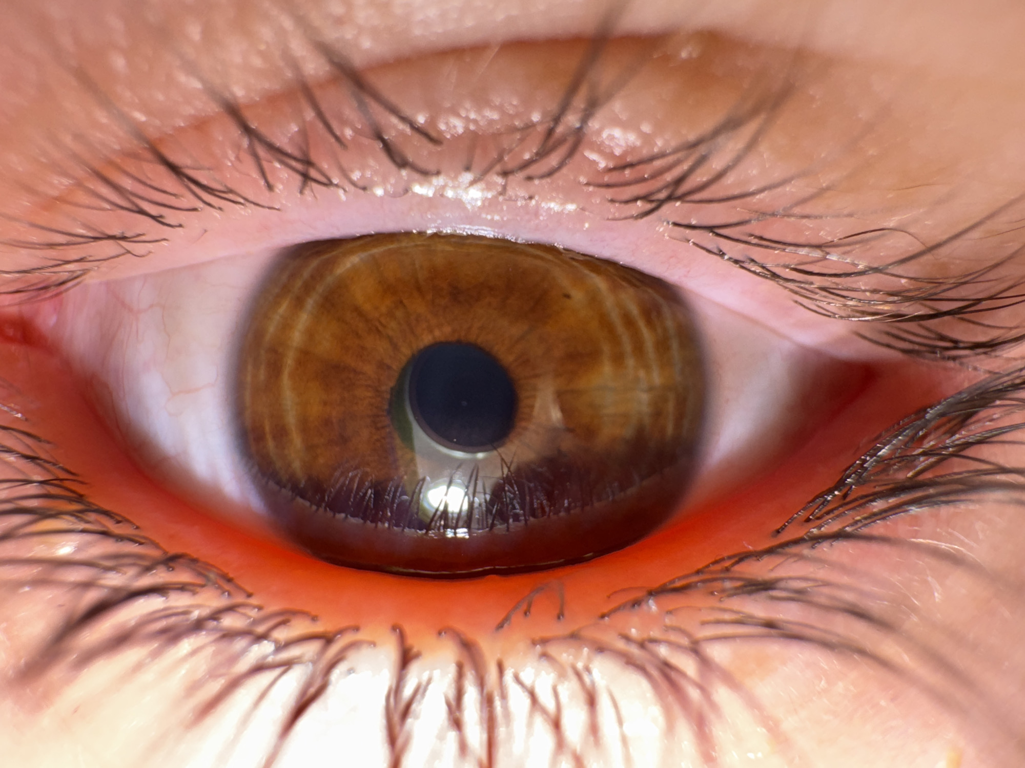 The image presents a highly magnified, frontal view of a human eye. The iris is a rich brown color, exhibiting intricate radial striations. A dark, circular pupil occupies the center of the iris, displaying a prominent, bright, circular reflection indicative of a direct light source. The visible sclera is white, interlaced with fine red capillaries, particularly noticeable in the lower right and upper left portions of the eye. The eyelids present a pinkish-orange complexion with visible skin texture and creases. Numerous dark eyelashes extend from both the upper and lower eyelids. Small, white, crystalline or flaky particulate matter is observed adhering to several individual eyelashes on both the upper and lower lids, as well as along the skin margin of the lower eyelid. The inner rims of the eyelids appear moist and reddish. The location is not identifiable from the image content.