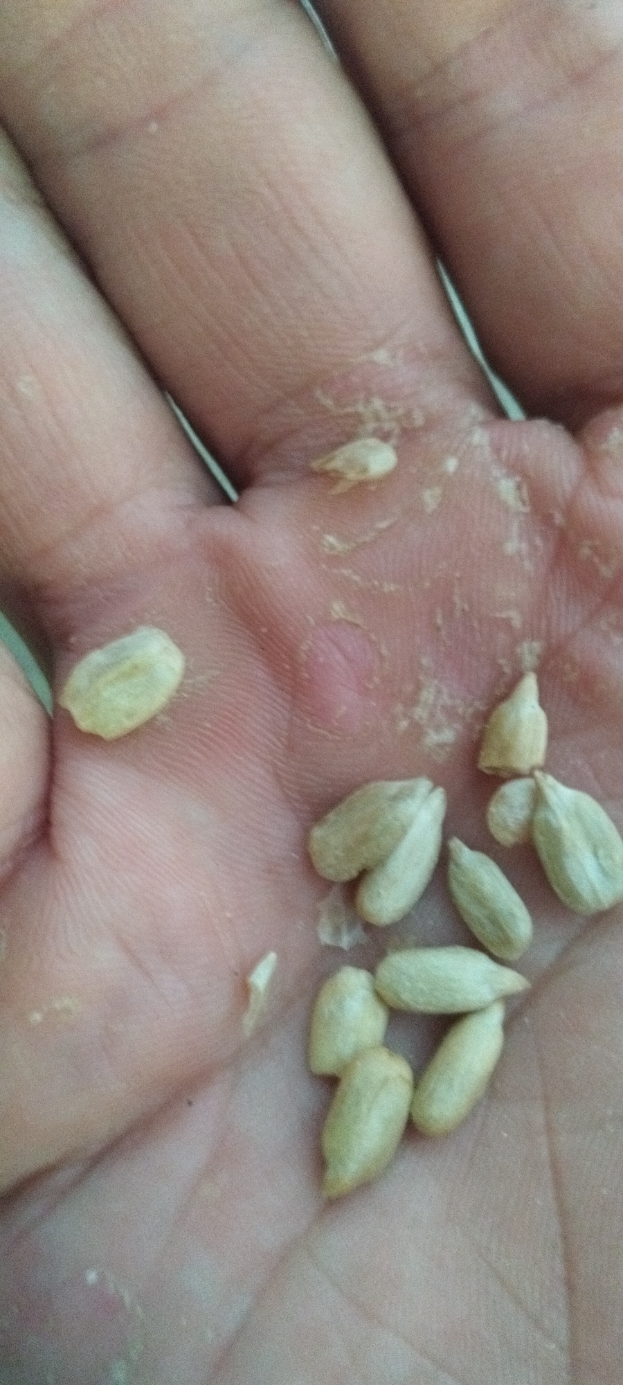 A close-up, overhead shot shows a person's palm and fingers in Yaroslavskaya, Russia, covered in several pale, oval-shaped sunflower seeds. The skin of the palm appears dry and slightly flaky, with some light pink areas suggesting irritation or dryness. The seeds are scattered across the palm and fingers, with some clustered together and others isolated. The lighting is bright, highlighting the texture of the skin and the surface of the seeds.