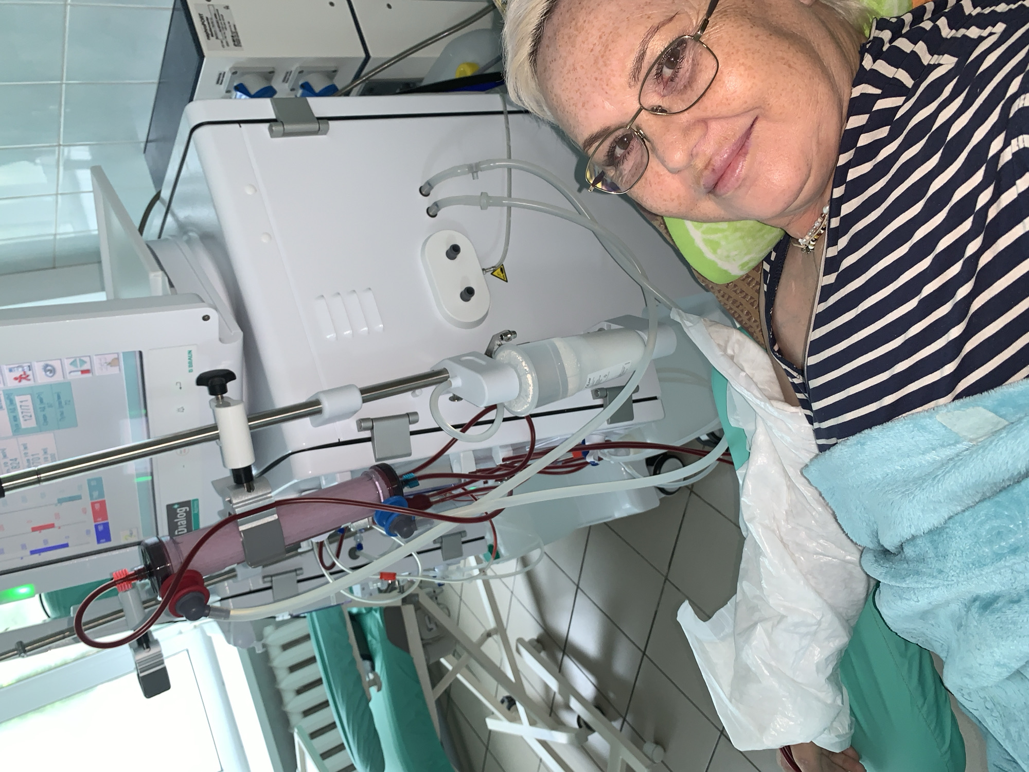 The image captures an older woman undergoing a medical procedure, most likely dialysis, within a clean, clinical environment. The woman, who has short light blonde hair and is wearing glasses, lies comfortably on what appears to be a hospital bed or recliner. She is dressed in a dark blue and white striped shirt and is partially covered by a soft, light blue blanket. Her expression is calm and pleasant, with a gentle smile directed towards the camera, suggesting a relaxed demeanor despite the treatment.
To her left, a large white medical machine is prominently featured. This machine is identifiable as a B. Braun "Dialog" model, indicated by visible text on its screen and casing. Various tubes, both clear and red, are connected to the machine and to a cylindrical blood filter, which contains a pinkish fluid, indicative of blood being processed. The machine's digital screen displays several numerical readings and graphical data, including figures such as "127/71", "624", "701", and "72". A yellow warning symbol, a triangle with an exclamation mark, is also visible on a white component of the setup.
The background shows white tiled walls, characteristic of a hospital or clinic. A glimpse of natural light suggests it is daytime. Above the medical machine, a black box labeled "NEWPORT" with blue electrical sockets is mounted. The overall scene depicts a patient receiving routine medical care in a well-equipped facility. The location is consistent with a modern medical setting, possibly in Chaikovsky, Russia.