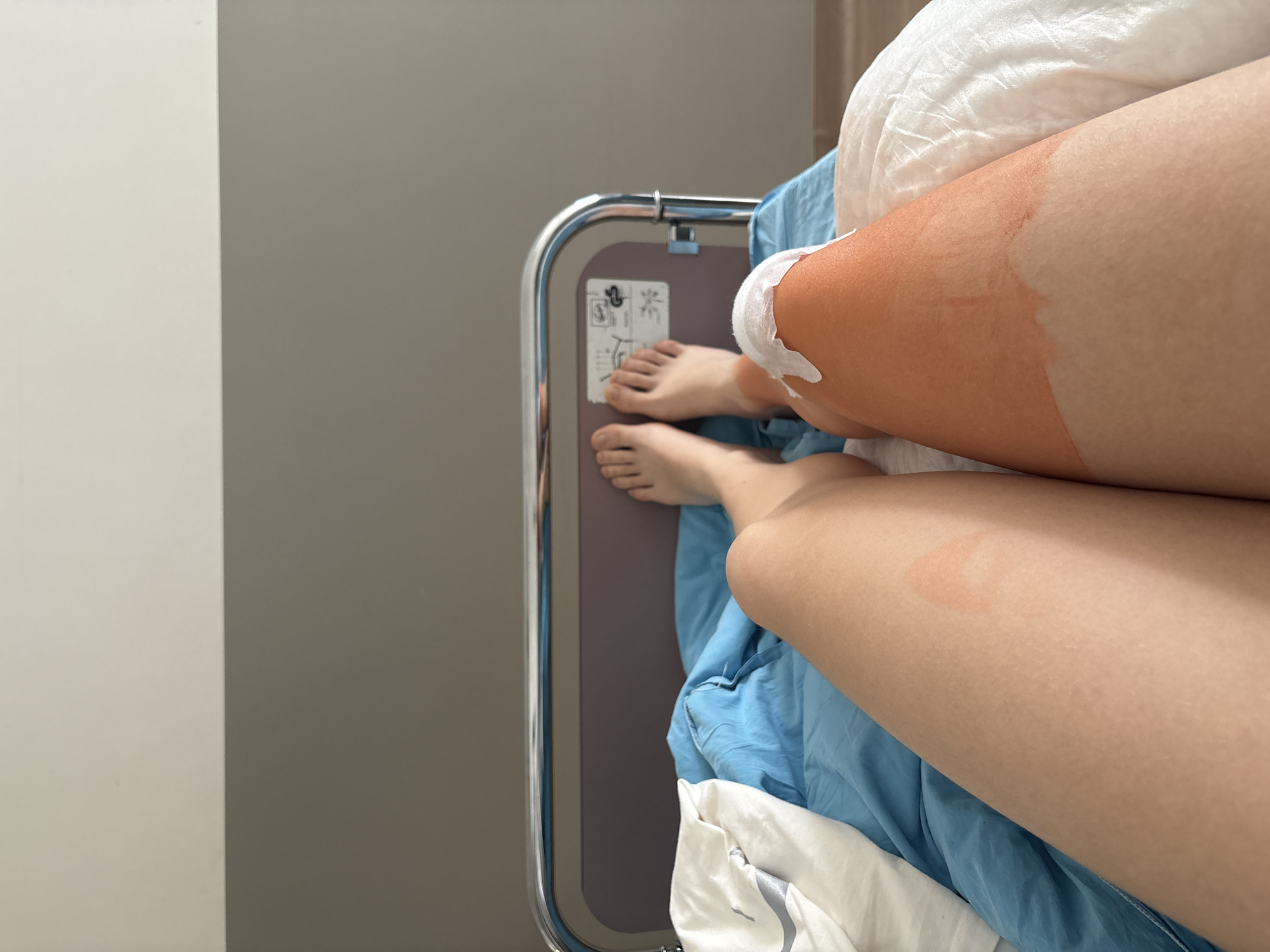 A close-up, high-angle shot depicts a person lying in a hospital bed. The person's legs, partially covered by a blue blanket and a white pillow, are visible. One leg is wrapped in a white bandage, and there is a distinct sunburn line and a round red mark on the exposed skin. The person's feet rest on the side rail of the hospital bed, which is made of metal and has a gray panel with printed instructions. The background shows a plain gray wall. The location is presumed to be inside a hospital setting. This image doesn't contain information that confirms its location in the city of Sofia, Bulgaria.