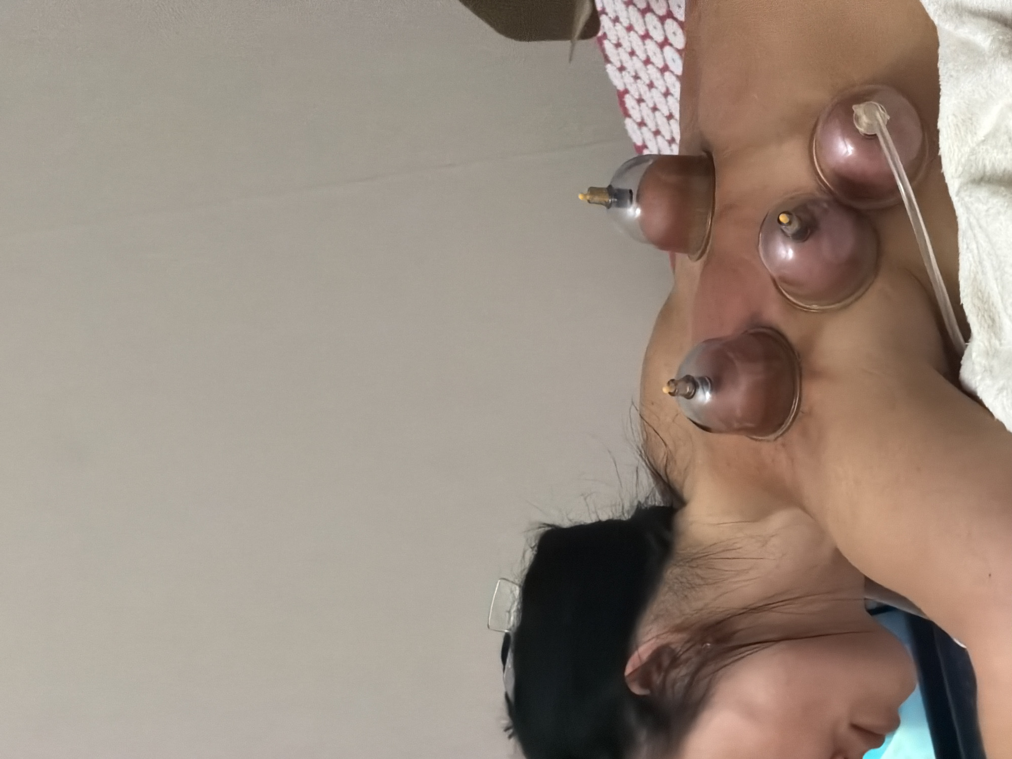 The image shows a close-up of a person's upper back and neck, with several glass suction cups applied to the skin. The cups are round and translucent, with some appearing to have a reddish or purplish hue where they are attached to the skin. A clear tube is connected to one of the cups, suggesting a method of creating suction. The skin beneath the cups is visibly red and appears slightly bruised, consistent with the practice of cupping therapy. The person's dark hair is visible, framing their ear and part of their face, which is turned away from the camera. A white towel or cloth is visible in the background, along with a section of a textured red and white mat. The lighting suggests an indoor setting, possibly a treatment room. No text is visible in the image. The context of Saint Petersburg, Russia, does not provide specific visual cues within the image itself. The activity depicted is cupping therapy, a traditional alternative medicine technique.