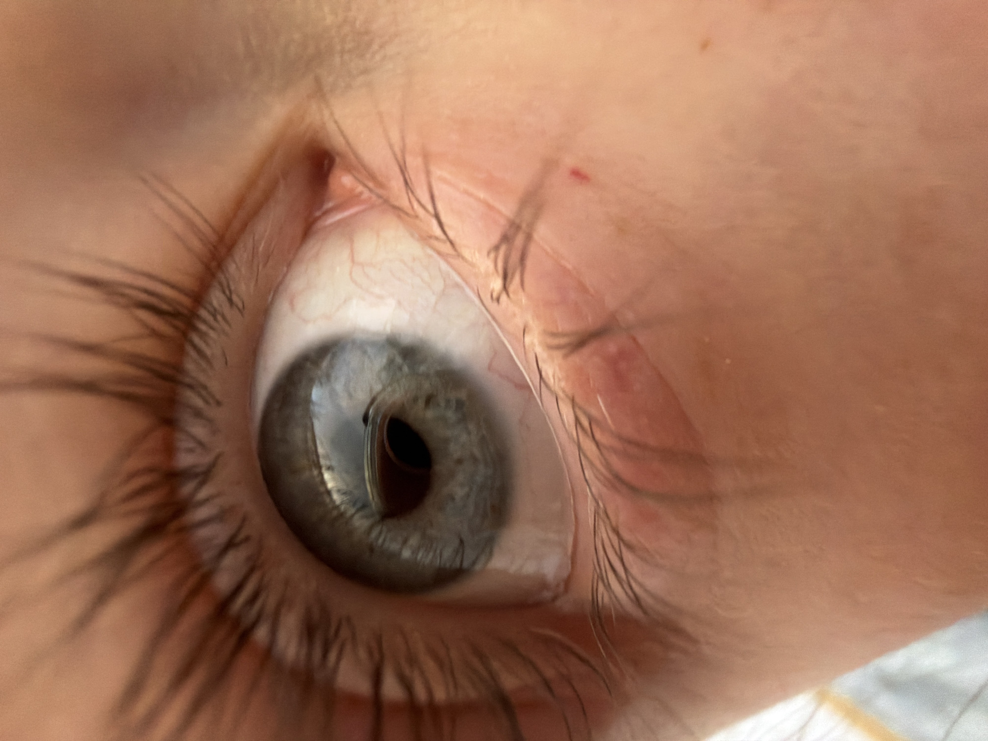 The image presents an extreme close-up of a human eye, likely belonging to a child or young person, characterized by smooth skin and long, fine eyelashes. The eye features a grey-blue iris with subtle brown specks near the dark, round pupil. A soft contact lens is clearly visible on the surface of the eye, slightly altering the appearance of the iris and the reflections.
The eyelashes are long, dark, and numerous, framing the eye. The sclera (white of the eye) appears clear, with delicate red blood vessels visible, especially towards the inner corner. The surrounding skin of the eyelids is light-toned and shows some subtle texture, with a small, reddish mark or lesion on the upper eyelid, directly above the eyelashes. Another faint red spot is visible further up on the skin. A bright reflection, consistent with an indoor light source or window, is prominent within the pupil and on the contact lens. The background consists of blurred human skin. No specific activity is depicted other than the eye being open. There is no visible text. The image provides no information about the time of day, weather, or emotions. The provided context indicates the image was taken in Perm, Russia.