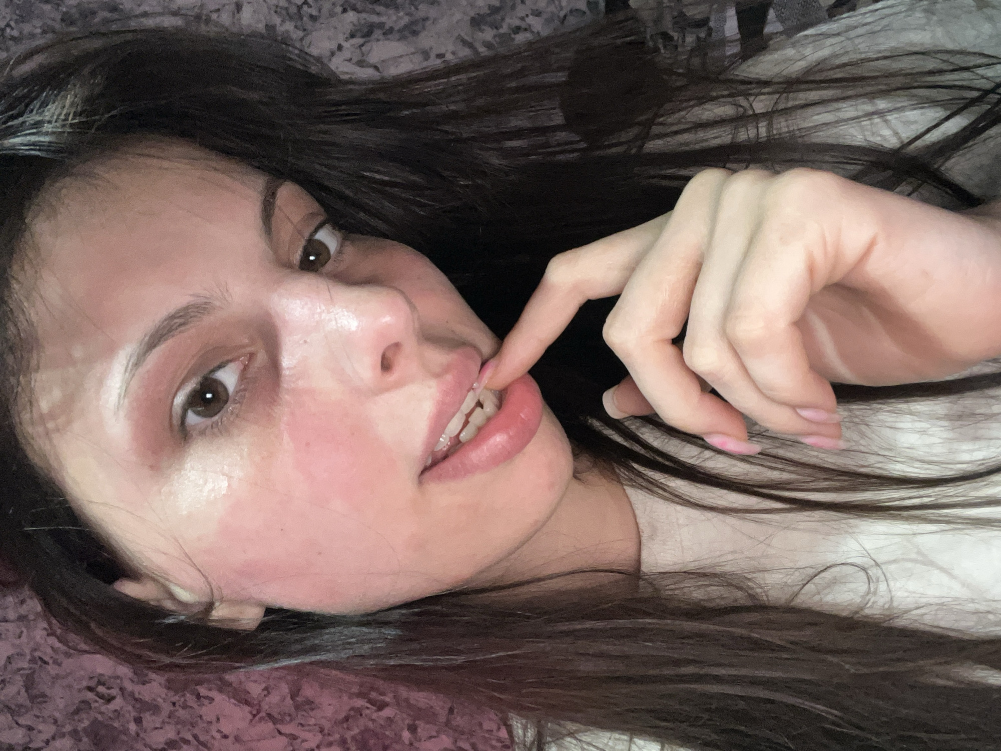 A woman lies on a patterned surface, possibly a bedspread or blanket. She has long, dark hair and brown eyes. Her face has some areas of redness, particularly around her eyes and cheeks. Her right hand is near her face, with one finger touching her lips. The background is out of focus. The location is not discernible from the image.