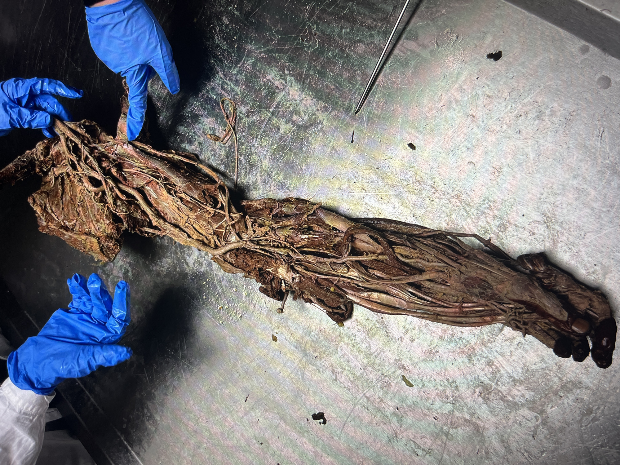 A partially dissected human arm is present on a metallic surface. Two hands wearing blue surgical gloves are positioning the upper portion of the arm. A surgical tool is near the upper portion of the arm. The exact location is unknown.