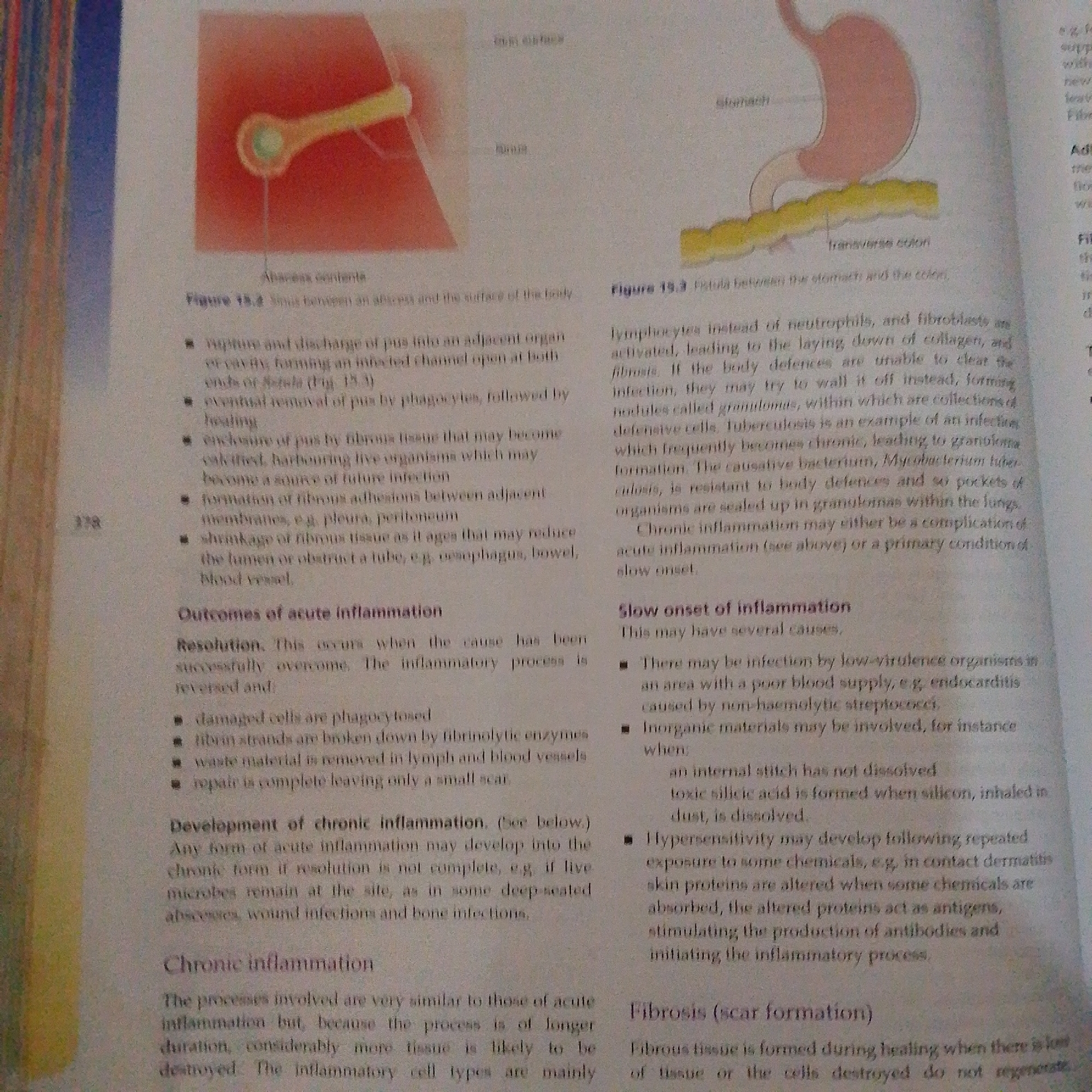 The image displays a page from a textbook discussing inflammation and related medical concepts. There are two diagrams illustrating medical conditions. The first diagram, labeled "Figure 15.2 Abscess contents," shows a cross-section of an abscess. The second diagram, labeled "Figure 15.3 Fistula between the stomach and the colon," depicts a connection between these two organs. The text provides descriptions of abscesses, fistulas, and the outcomes of acute inflammation, including resolution and chronic inflammation. It also touches upon fibrosis, or scar formation.
There is no information in the image that would allow for the determination of its location in Jalingo, Nigeria, or any other city. The image is a depiction of medical illustrations and text, not a photograph of a real-world scene.