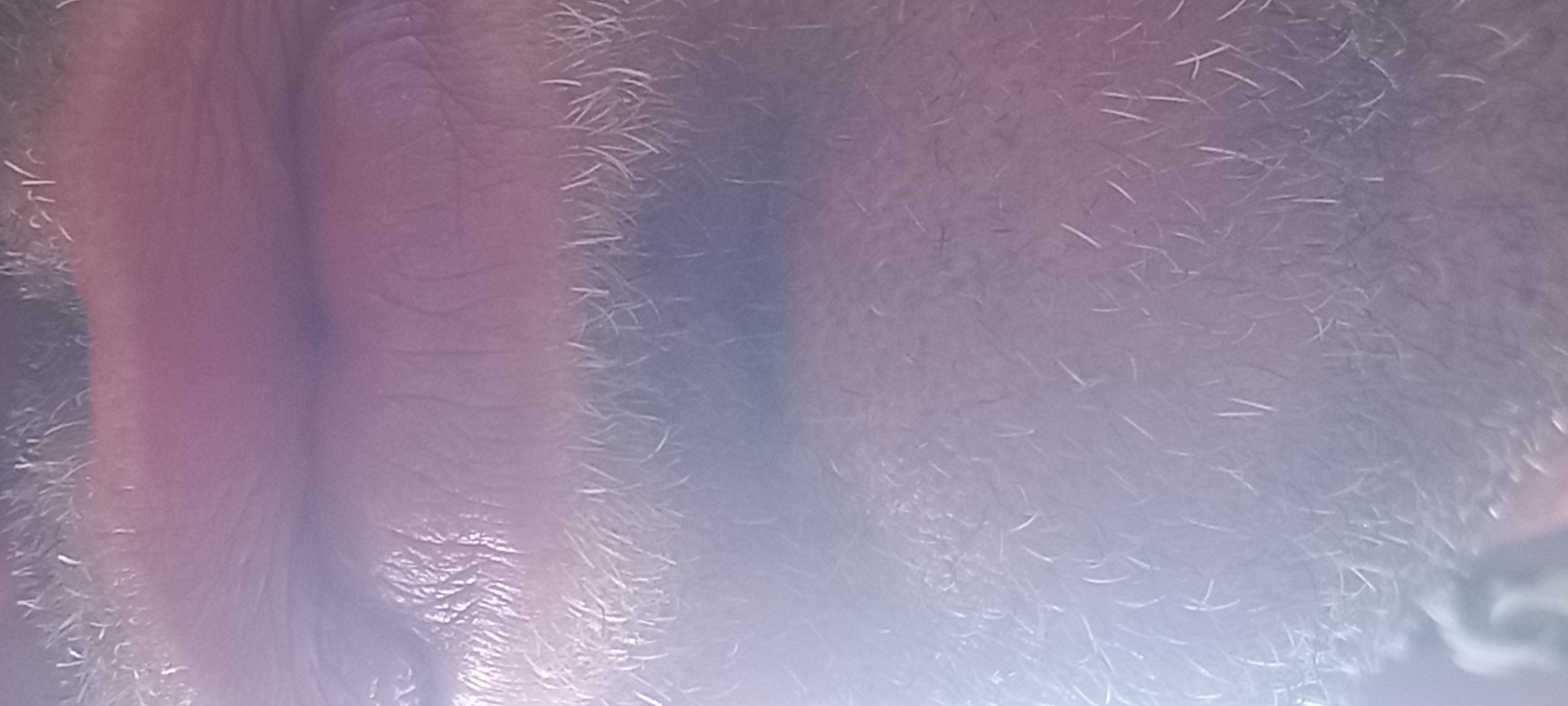 This is a close-up, vertical photographic image depicting the lower facial region of an adult individual, reportedly located in Kryvyi Rih, Ukraine. The subject's upper lip, lower lip, and the surrounding perioral and mental (chin) areas are visible. The upper lip exhibits a reddish-pink coloration with fine wrinkles, appearing somewhat dry or chapped. Centered between the upper and lower lips, a distinct, dark purplish-blue discoloration, consistent with a hematoma or bruising, is evident, extending slightly onto the central part of the lower lip. The lower lip appears fuller than the upper, showing a lighter purplish-pink hue and fewer prominent wrinkles. The skin around the lips and on the chin is densely covered with short, coarse stubble, predominantly white or light grey, indicating beard growth. No other discernible objects, actions, or interactions are visible. The background is uniformly blurred and indistinct, suggesting a very close focal distance and limited depth of field. The lighting is diffuse, without harsh shadows.