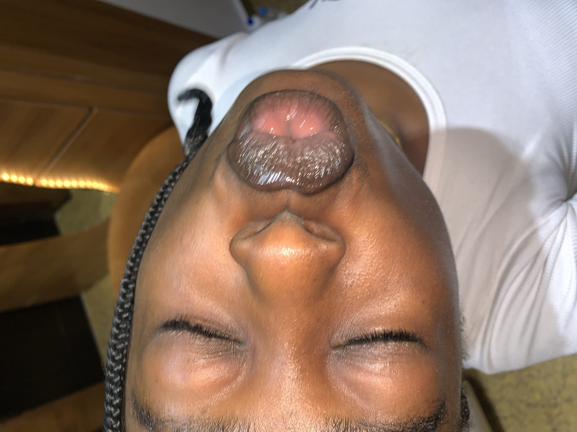 The image shows a close-up view of a person's face, with their eyes closed and their head tilted to the side. The person has dark skin and their hair is styled in braids. There is a dark, shiny, and slightly raised lesion on the person's upper lip, which appears to be inflamed and possibly raw in the center. The person is wearing a white ribbed t-shirt. The background is blurred but appears to be an indoor setting with wooden furniture and some lighting. The image does not provide any information about the location in Gura Top, Nigeria.