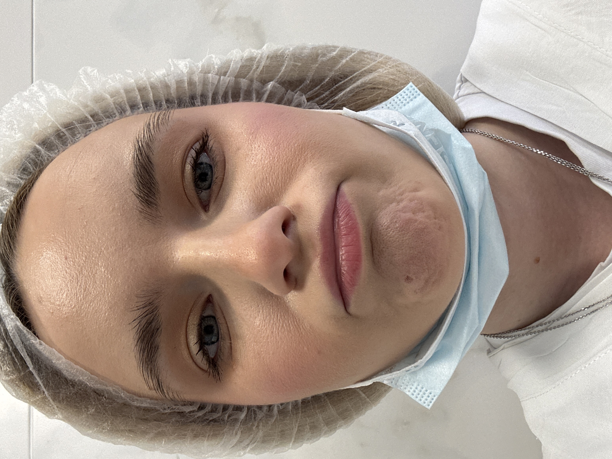A young woman lies on a white surface, likely a medical examination table, wearing a disposable white hairnet and a light blue surgical mask pulled down to reveal the lower portion of her face. She has fair skin, light-colored hair under the net, well-defined eyebrows, and visible eyelashes. Her eyes are open, and a silver chain necklace is visible against her white shirt. There is a visible skin condition, likely scarring, on the right side of her jawline. The background appears to be a clean, white environment, suggesting a medical or cosmetic setting. The location cannot be determined as Saint Petersburg, Russia, as no specific environmental features allow for that conclusion.