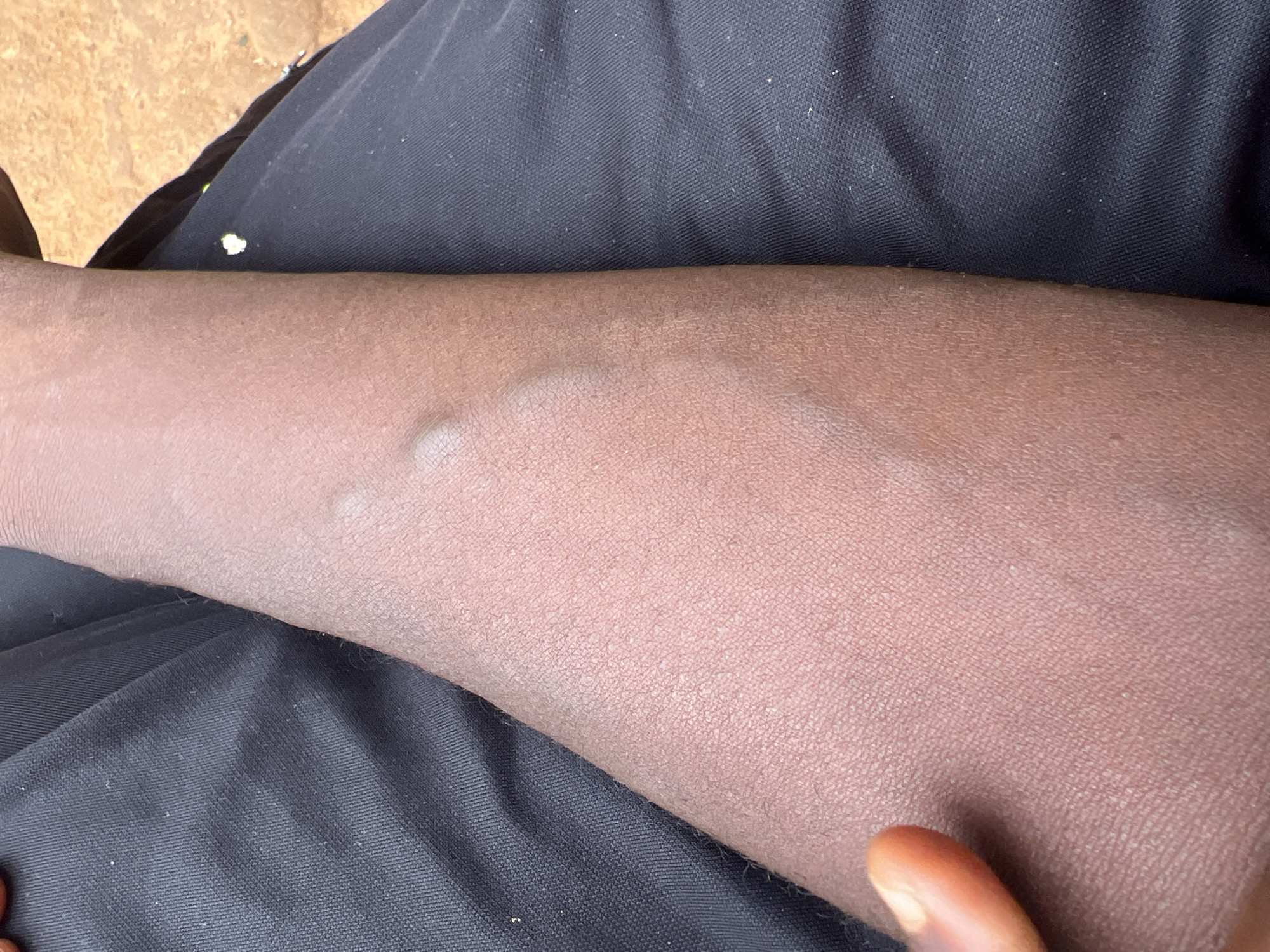 The image shows a close-up of a person's forearm, resting against dark fabric, likely clothing. The skin appears to have some dryness or flakiness. There are a few small, light-colored raised bumps or marks on the arm. The background is out of focus but appears to be an outdoor setting with reddish-brown earth. The scene is not specific to Jos, Nigeria, or any identifiable location.