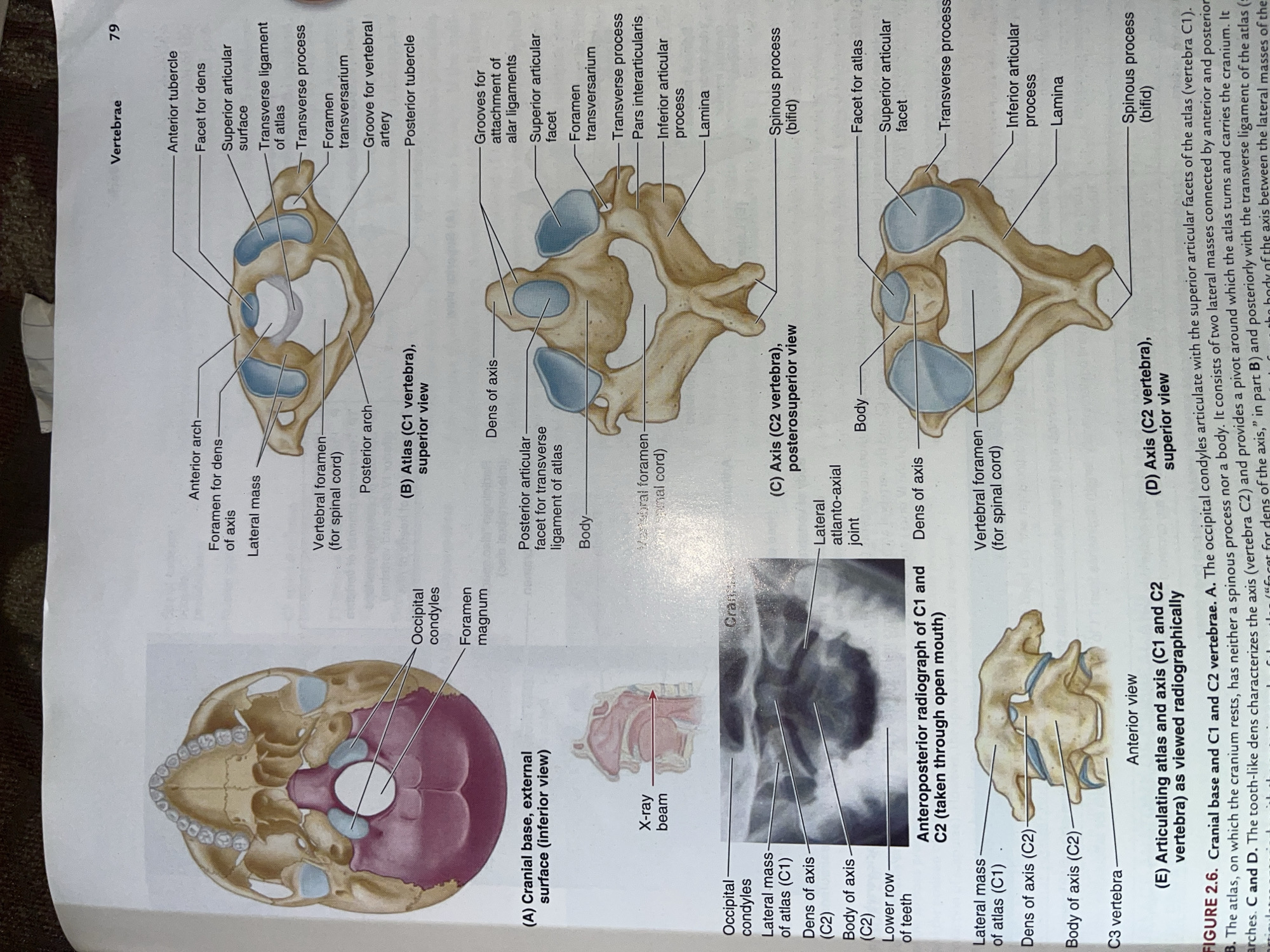 The image displays anatomical illustrations of the human skull base and the first two cervical vertebrae (C1, atlas, and C2, axis). It includes diagrams labeled (A) Cranial base, external surface (inferior view), (B) Atlas (C1 vertebra), superior view, (C) Axis (C2 vertebra), posterosuperior view, and (D) Axis (C2 vertebra), superior view. Additionally, there is an anteroposterior radiograph of C1 and C2 taken through an open mouth, and a diagram labeled (E) Articulating atlas and axis (C1 and C2 vertebra) as viewed radiographically. The text below the images provides descriptive information about these anatomical structures. The image is a page from a textbook, indicated by the page number '79' and the title 'Vertebrae'. There is no information present in the image that relates to the city of Jalingo, Nigeria, or any forensic scene.