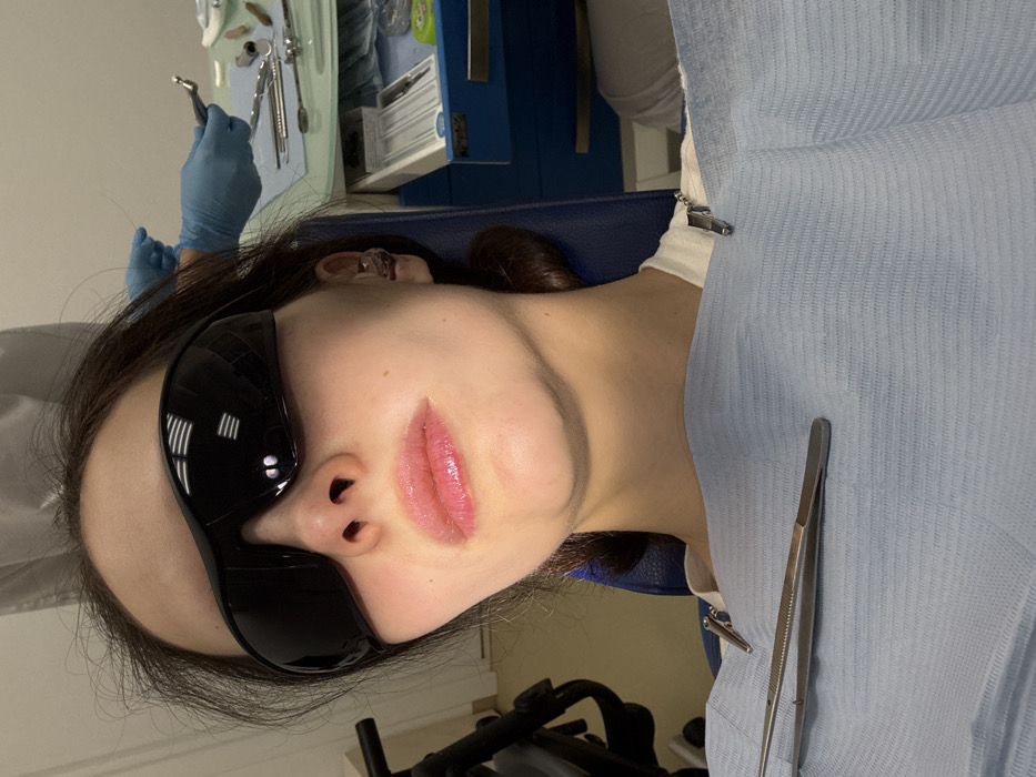 The image depicts a female patient seated in a dental chair within a clinical environment, specifically a dental office or clinic in Yekaterinburg, Russia. The precise address or name of the facility is not discernible from the visual information.
The patient, a young adult with dark brown hair, is positioned centrally, looking directly towards the viewer. She wears large, black, full-coverage protective sunglasses/goggles. Her lips are a light pink color with a noticeable glossy finish. A light blue disposable dental bib is secured around her neck by two silver-colored clips, one visible on each side. Resting on the bib, positioned horizontally across her chest, is a pair of silver-colored, serrated-tip dental tweezers. A small, transparent or silver-toned stud earring is visible in her right earlobe.
In the background, to the patient's right, a dental professional's arm and hand are visible, encased in blue disposable gloves. This individual holds a silver-colored dental handpiece (drill) in their right hand. The professional is positioned near a dental tray covered with a light blue disposable mat, upon which an assortment of sterile dental instruments is arranged. These instruments include various metal probes, mirrors, and other specialized tools, alongside small containers and a white box containing numerous thin, white-tipped applicators or tubes. Below the tray, part of a blue and white multi-drawer dental cabinet is visible. A second individual, partially visible, is seated in the far right background, wearing a white garment. The overall environment is brightly lit and consistent with a sterile medical treatment room.