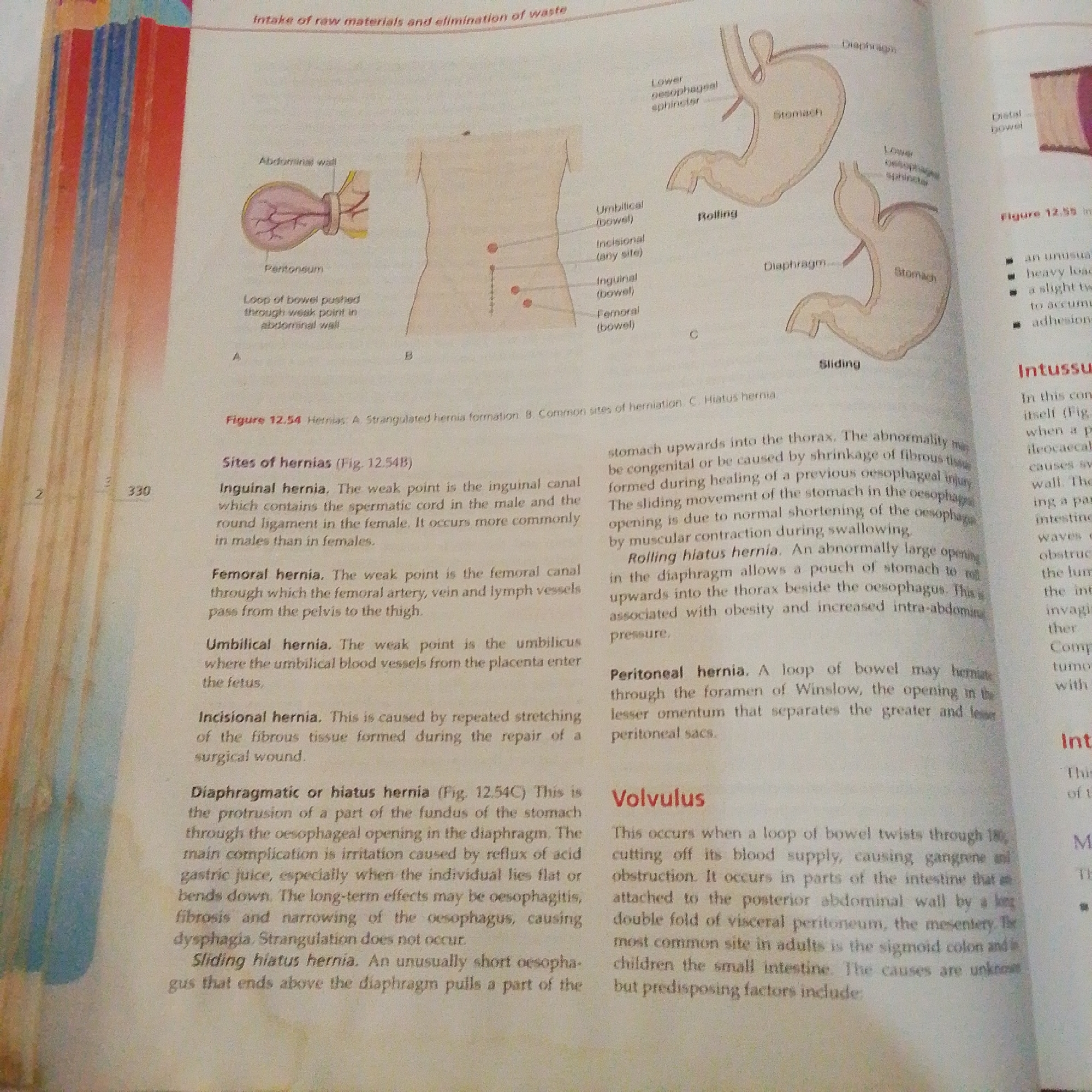 The image is a photograph of an open textbook, likely a medical or biology textbook, showing diagrams and text related to hernias and other gastrointestinal conditions. The subjects are illustrations of the human anatomy, specifically the abdominal region and the stomach, as well as textual descriptions of medical terms.
The scene is a close-up of an open book lying on a flat surface, likely a table or desk. The background is out of focus, but appears to be a typical indoor setting, possibly a classroom or study area. There are no people directly visible, but the content of the book implies a context of human anatomy and health.
The primary activity taking place is educational, with the textbook serving as the medium for conveying information. The diagrams illustrate different types of hernias, including inguinal, femoral, umbilical, incisional, and hiatal hernias, with labeled parts of the anatomy such as the abdominal wall, peritoneum, and diaphragm. The text explains the formation, causes, and effects of these conditions. There is also a section on "Volvulus" and "Intussusception."
Notable details include the specific diagrams: one shows a loop of bowel pushed through a weak point in the abdominal wall (strangulated hernia formation), another displays common sites of herniation on the torso, and two diagrams illustrate "rolling" and "sliding" hiatal hernias. The text also provides definitions and explanations of these medical conditions.
The visible text includes titles such as "Intake of raw materials and elimination of waste," "Figure 12.54 Hernias," "Sites of hernias," "Inguinal hernia," "Femoral hernia," "Umbilical hernia," "Incisional hernia," "Diaphragmatic or hiatus hernia," "Sliding hiatus hernia," "Peritoneal hernia," "Volvulus," and "Intussusception." There are also page numbers visible, such as "330." The context "Jalingo, Nigeria" suggests the book might be used in an educational institution in that location, but there are no direct visual cues in the image to confirm this. The lighting is bright, suggesting it is daytime or under artificial lights. There are no obvious emotional cues as the image focuses on illustrative and textual content.