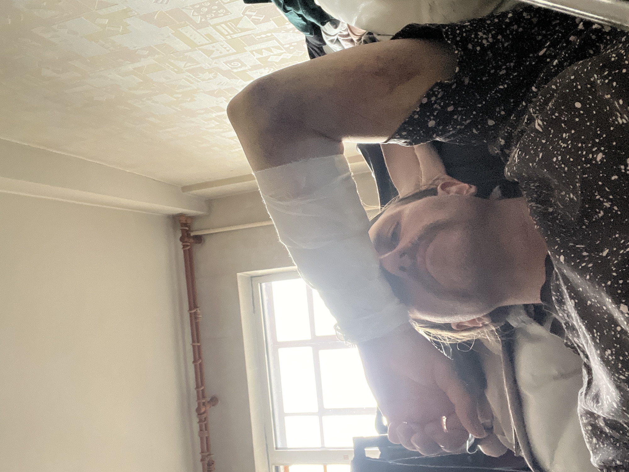 An inverted, overhead shot captures an individual lying down indoors, looking up towards the camera. The person, likely an adult, is visible from the chest upwards, angled with their head towards the bottom right of the frame. Their right arm (viewer's left) is bent and raised, featuring a noticeable white bandage or wrap around the forearm and elbow area. Above the bandage, on the upper arm, several dark bruises are visible. The person is wearing a dark shirt with a pattern of small, light-colored speckles. Their facial expression appears neutral.
The setting is an indoor room, illuminated brightly by natural light streaming through a multi-paned window positioned in the mid-left background. To the left of the window, a light-colored wall features a vertical reddish-brown pipe, possibly part of a heating or plumbing system, with visible bindings or wraps at intervals. The ceiling, which dominates the upper portion of the image, is a light, off-white color with a distinct, embossed, or patterned texture, resembling geometric or abstract shapes. The overall impression suggests a moment of rest or recovery following an injury, with bright daylight illuminating the scene. No discernible text is visible in the image.