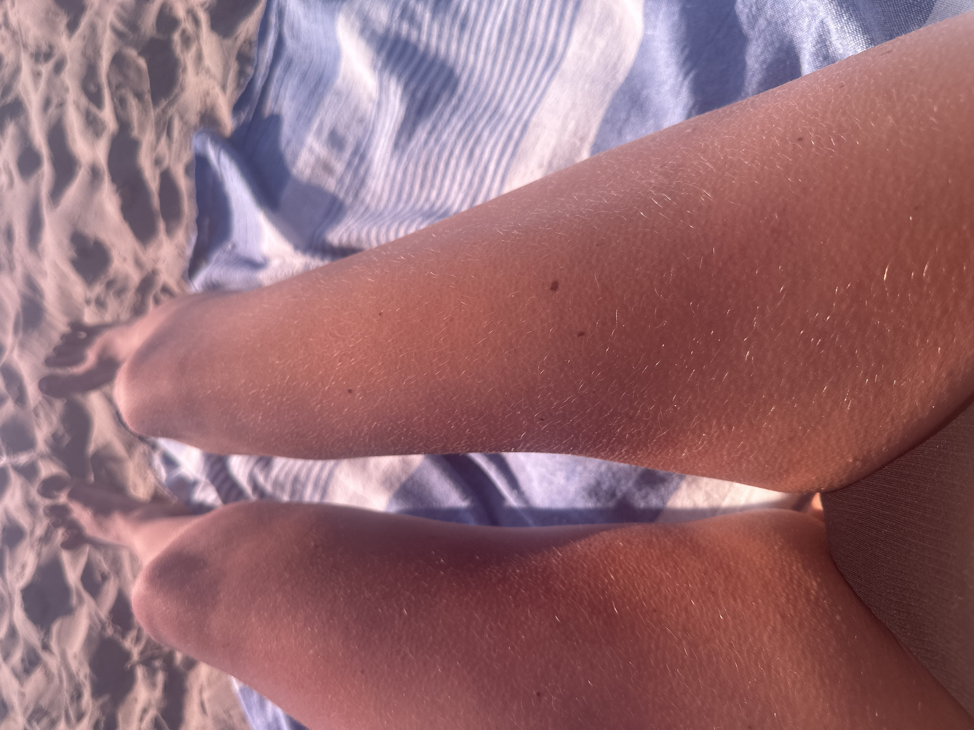 A close-up, overhead view shows a person's legs and feet resting on a striped beach towel on a sandy beach in Zandvoort, Netherlands. The person's skin is flushed pink, indicating a possible sunburn. The sand is light brown and textured with small dunes and shadows. The beach towel is blue and white striped, with the blue stripes appearing darker due to the lighting. The overall scene suggests a sunny day at the beach.