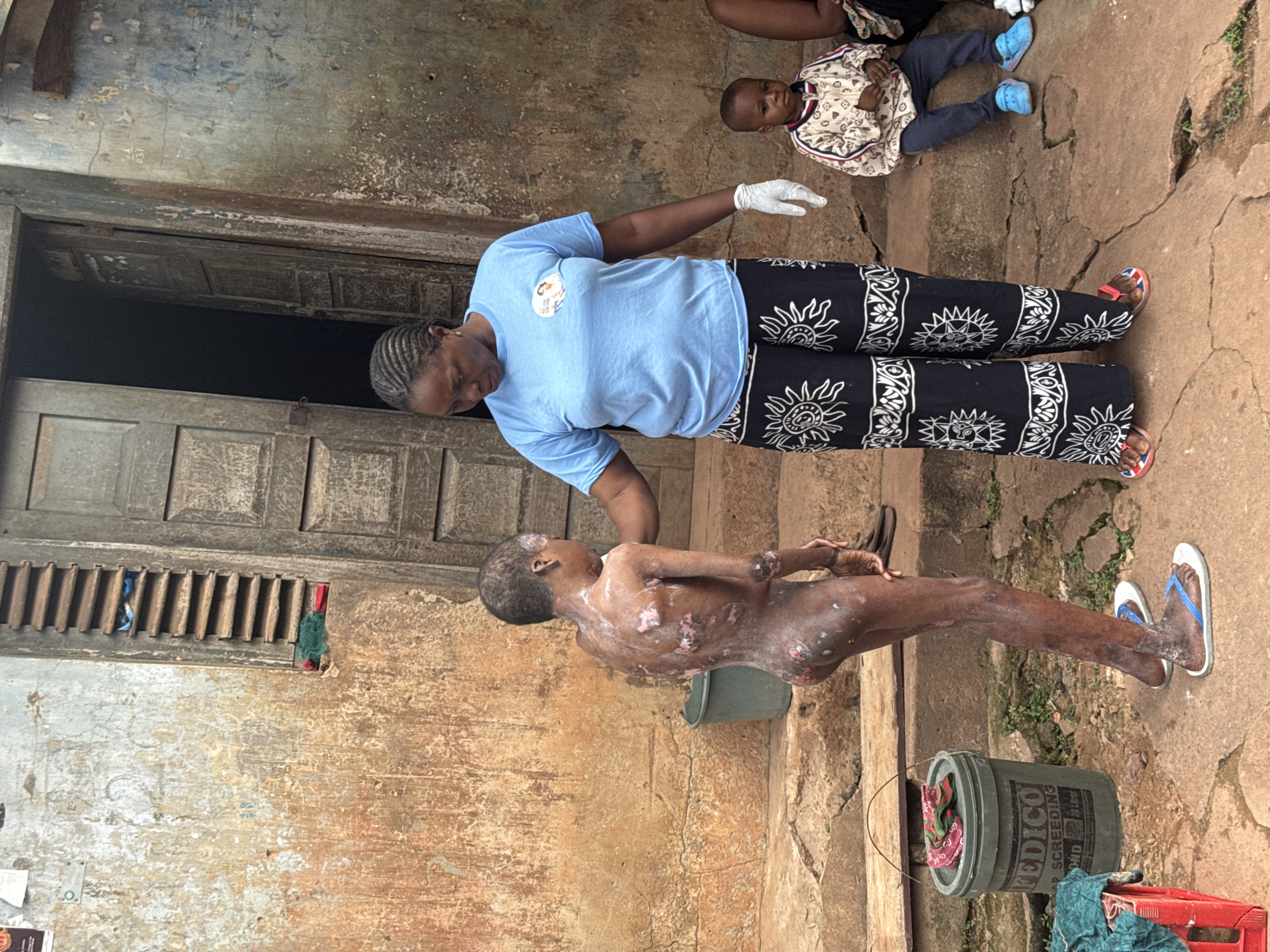 In a weathered, earthy-toned courtyard, likely in Enugu, Nigeria, a young person with severe skin lesions stands facing a woman. The young person, nude from the waist up, exhibits extensive areas of redness, peeling, and scabbing across their back, arms, and legs, suggesting a significant dermatological condition. They are wearing blue and white flip-flops. The woman, wearing a light blue t-shirt with a circular logo and black patterned pants, stands beside the youth, appearing to assist them. She has on white gloves. Behind them, a wooden door with vertical panels and a louvered window is set into a rough-hewn wall. To the right, a young child in a patterned jacket and blue Crocs sits on worn concrete steps, observing the scene. A green plastic bucket labeled "FEDICO" is visible to the left, near a red plastic crate with some green fabric. The ground is cracked concrete and dirt, with sparse vegetation.