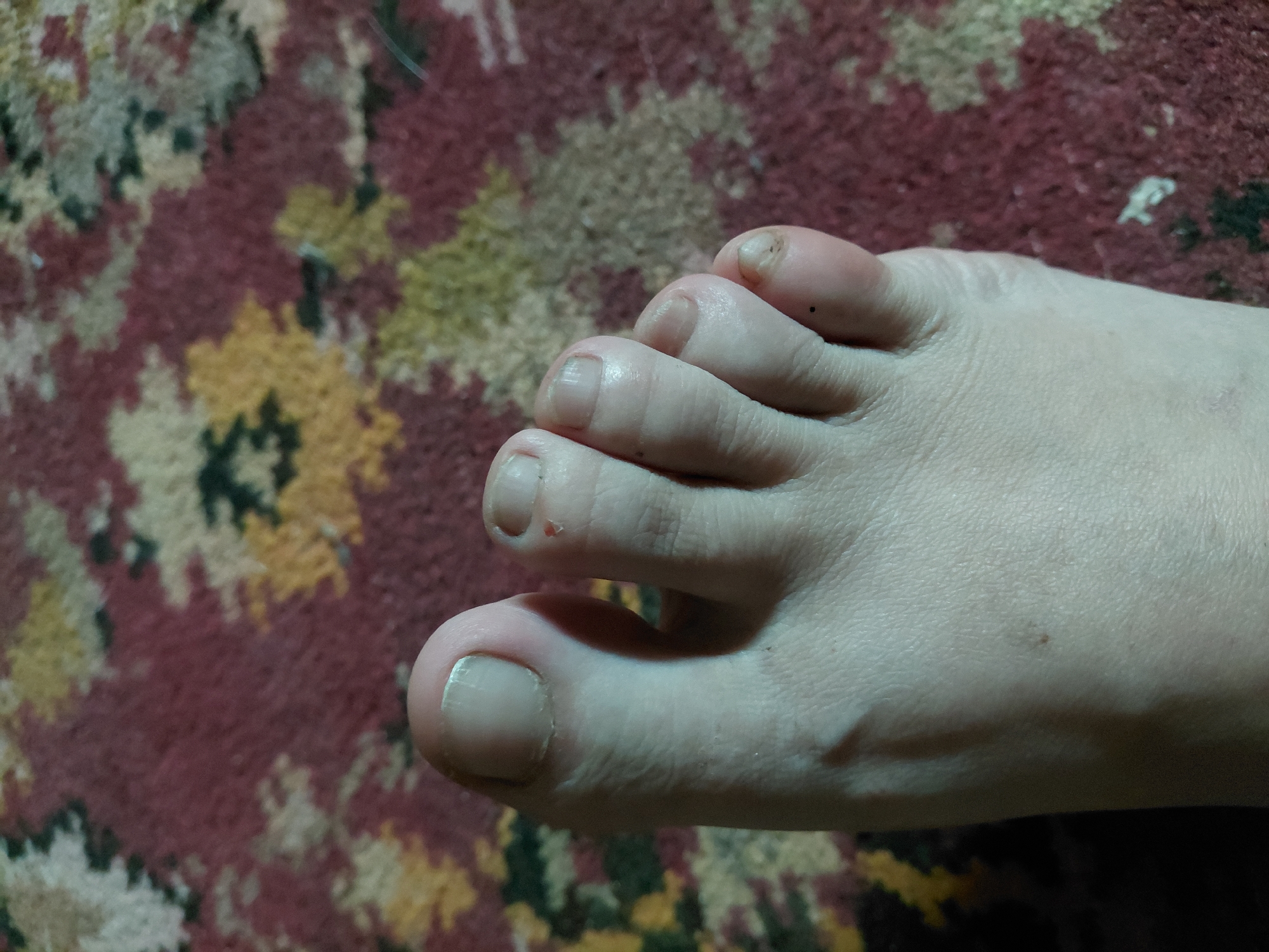 The image shows a close-up of a person's bare foot resting on a patterned carpet. The foot is pale with visible toenails. The toes are positioned at an angle, and the skin shows some texture. There are a few small dark spots on the skin of the foot, possibly moles. The carpet has a complex floral pattern with dominant colors of dark red, yellow, and muted green. The lighting appears to be artificial, casting shadows that highlight the contours of the foot. The scene is indoors, and there are no other elements in the frame besides the foot and the carpet. No text is visible in the image.