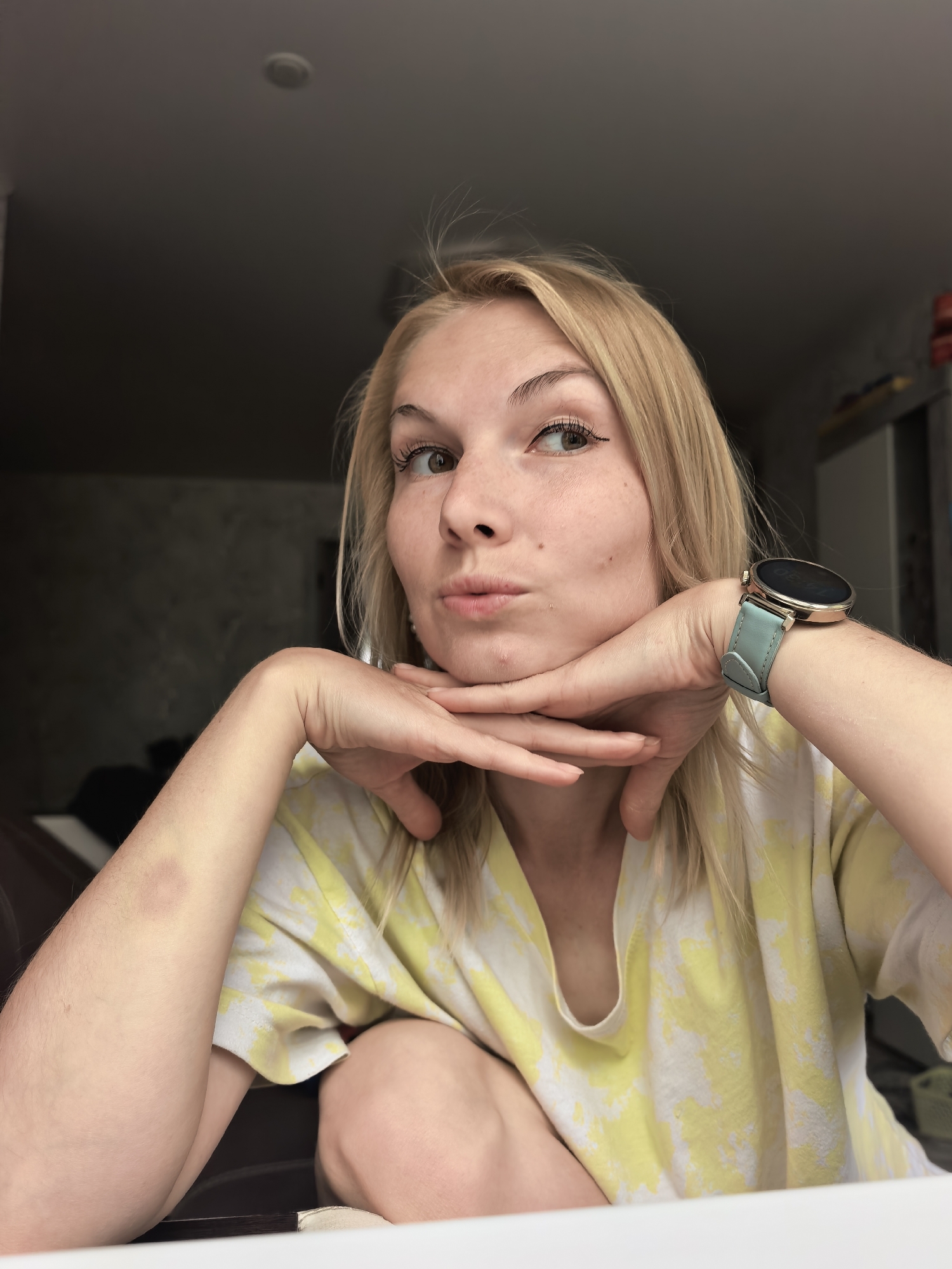 A blonde woman is posing with her chin resting on her interlaced hands, gazing upwards and slightly to her right with a puckered expression. She is wearing a yellow and white tie-dye shirt and a smart watch with a light blue band. A circular bruise is visible on her left arm. The background is blurred, but suggests an interior setting with furniture and a neutral-colored wall. The specific location in the city of Unknown, Unknown is indeterminate.