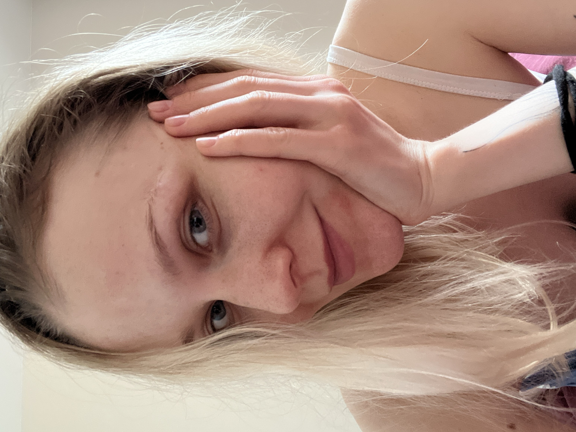 A fair-skinned woman with blonde hair is visible, with part of her face covered by her right hand. She has visible skin blemishes on her face. A white strap is visible on her shoulder. On her left arm, there is a medical bandage with a dark band, which could be a medical device attached. The background is blurred and appears to be a light color. The context does not give any information about Khimki, Russia.