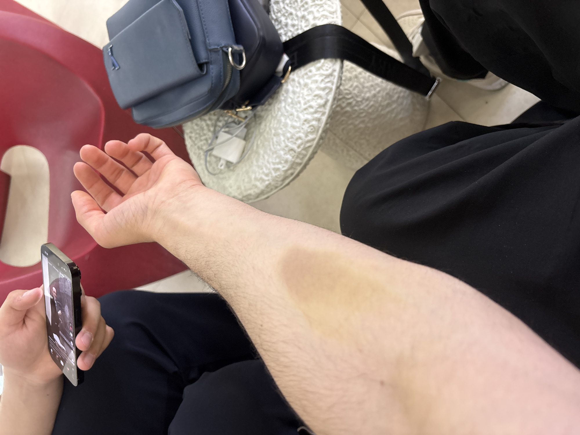 A first-person perspective image shows a person sitting down, holding a mobile phone in their left hand, and displaying a bruise on their right forearm. The phone screen shows a person, possibly a male figure, wearing a dark coat. Adjacent to the person's arm and hand are dark pants. To the left, a red chair is partially visible. Above, a light blue bag rests on a patterned white surface, possibly a chair. The bag has a black strap. No details indicate a specific location in Yerevan, Armenia.