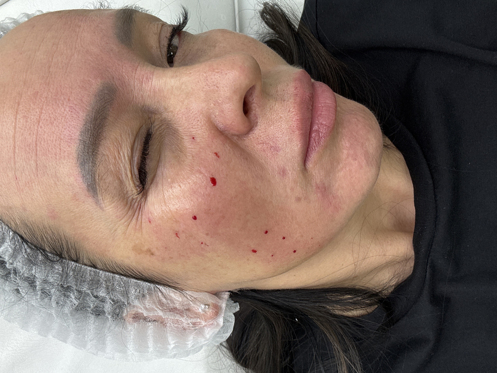 An image shows a woman lying on her back, presumably after a cosmetic procedure, given the small blood droplets on her face. She has dark hair and is wearing a white disposable cap. The background includes a white surface and a dark shirt. There is no specific information about the location in Izhevsk, Russia, or any other contextual information.