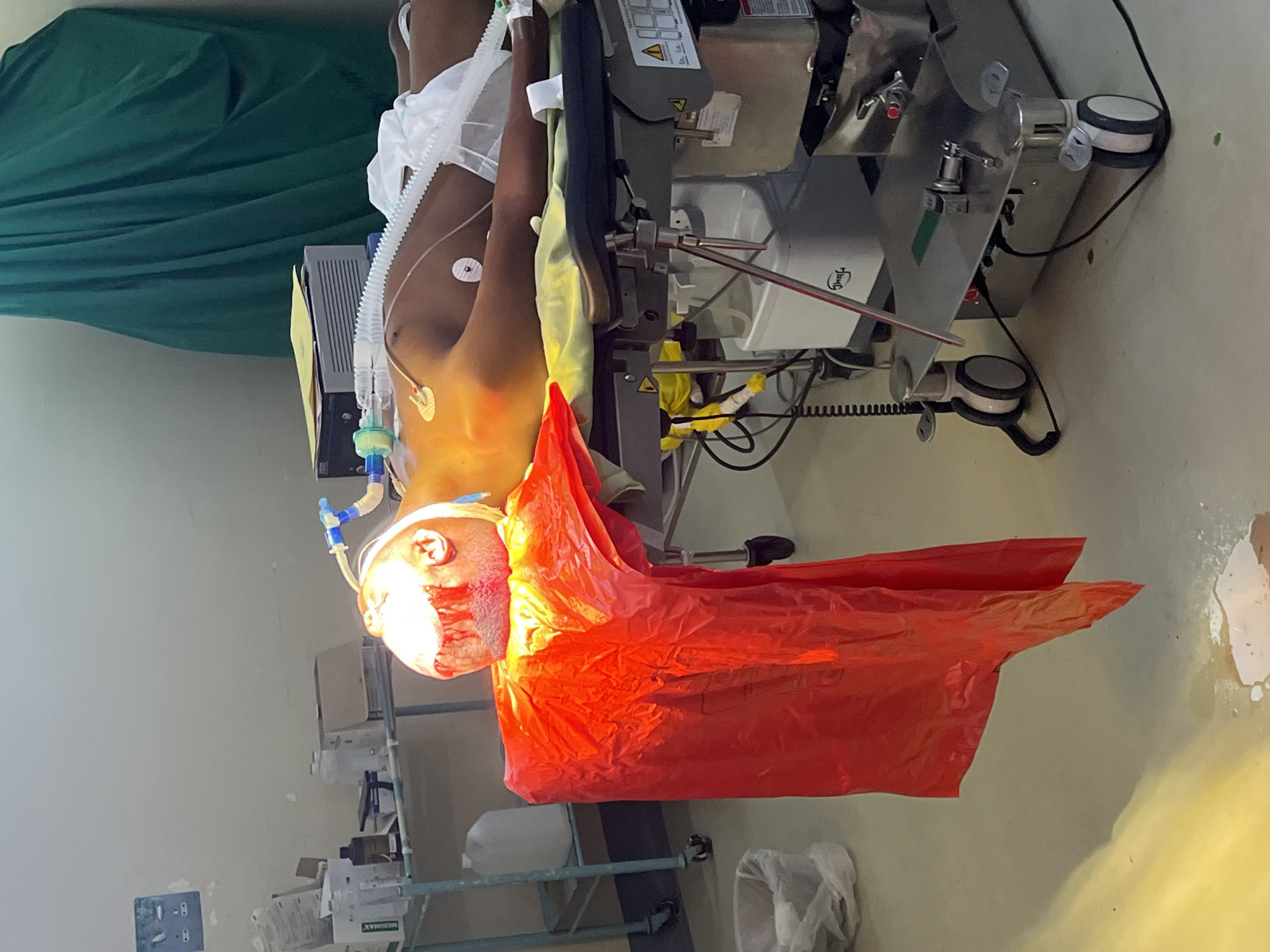 The image depicts a person lying on an operating table in what appears to be a medical facility. The individual's head is draped with a bright red surgical sheet, and their face shows signs of blood or post-surgical residue. They are intubated with a breathing tube connected to medical equipment. Electrocardiogram (ECG) leads are attached to their chest. The person's skin tone is medium to dark brown. The background includes surgical equipment with various tubes and cables, along with a green surgical drape. Based on previous analysis, the location is suspected to be in Nairobi, Kenya. The scene suggests a recent or ongoing surgical procedure.