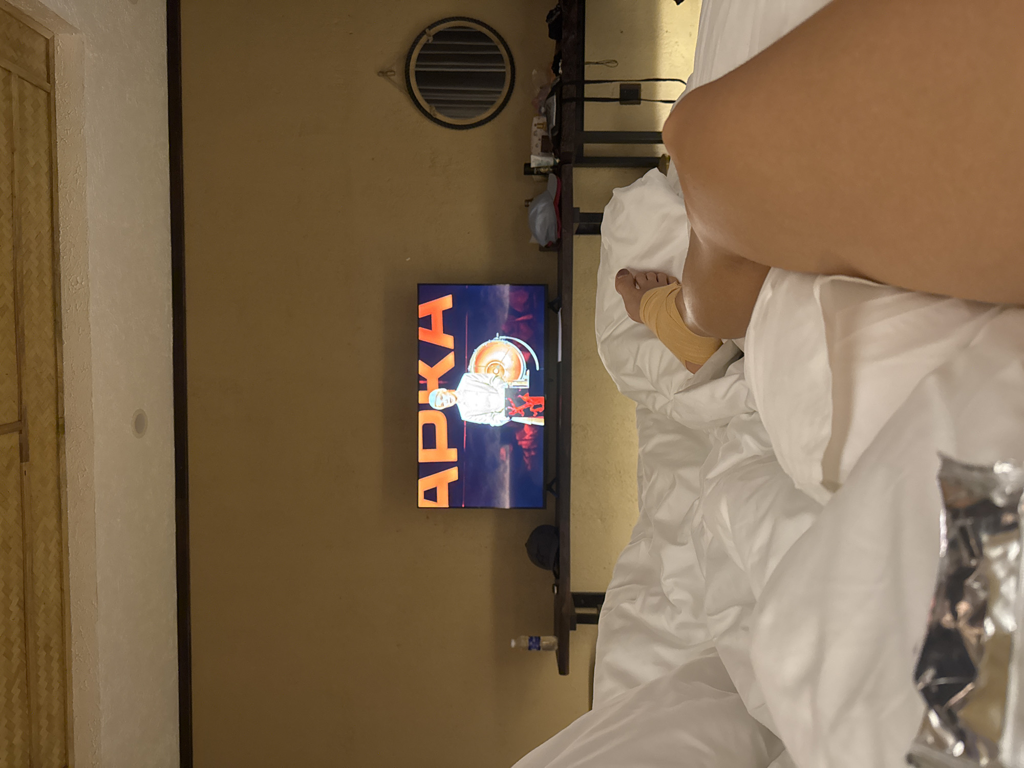 In a hotel room, a person is lying on a bed covered in white sheets. The camera focuses on their right leg, which is bandaged around the ankle with a tan elastic bandage. A silver wrapper is partially visible in the foreground on the bed. A television screen in the background displays the word "APKA" in large orange letters, with an image of a person in a white outfit superimposed over a colorful background. A shelf with a water bottle and a cap is visible below the television. To the right, a circular mirror hangs on a wall. The walls are a muted yellow, and the ceiling features a bamboo-like texture. The scene appears to be in Nam Hoa Lư Ward, Vietnam.