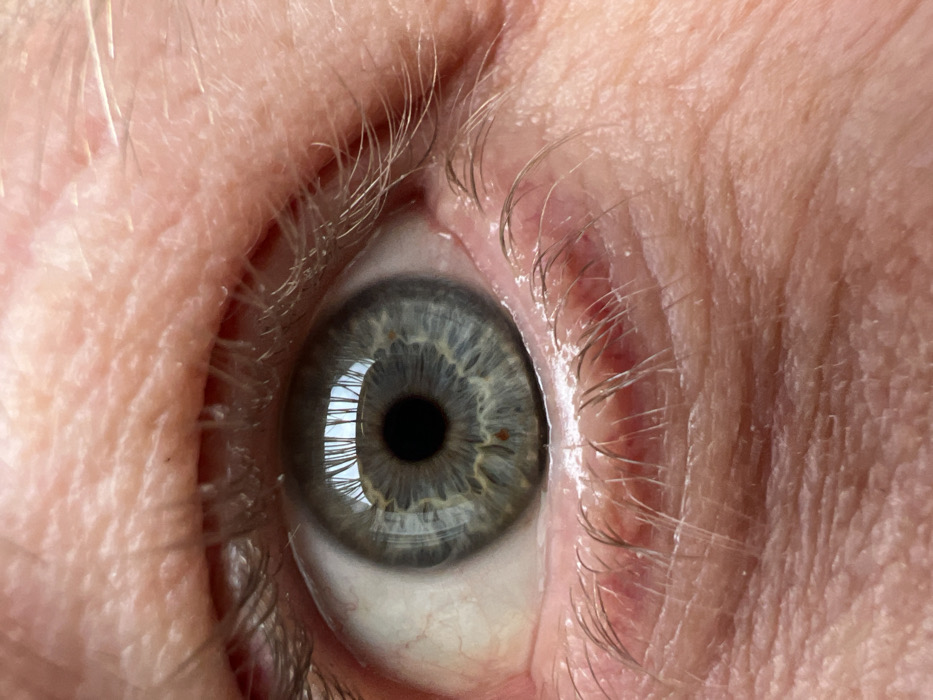 A forensic close-up image depicts a human left eye. The iris is blue-gray, featuring a dark central pupil and a distinct reddish-brown fleck located in its inferior aspect. Fine red blood vessels are visible on the white sclera, more prominent medially. Light-colored eyelashes are present on both upper and lower eyelids. The surrounding skin appears light-toned with visible fine lines and pores. A bright, structured reflection within the pupil and iris indicates an indoor environment with overhead illumination or a window. The depicted scene is located in Saint Petersburg, Russia.