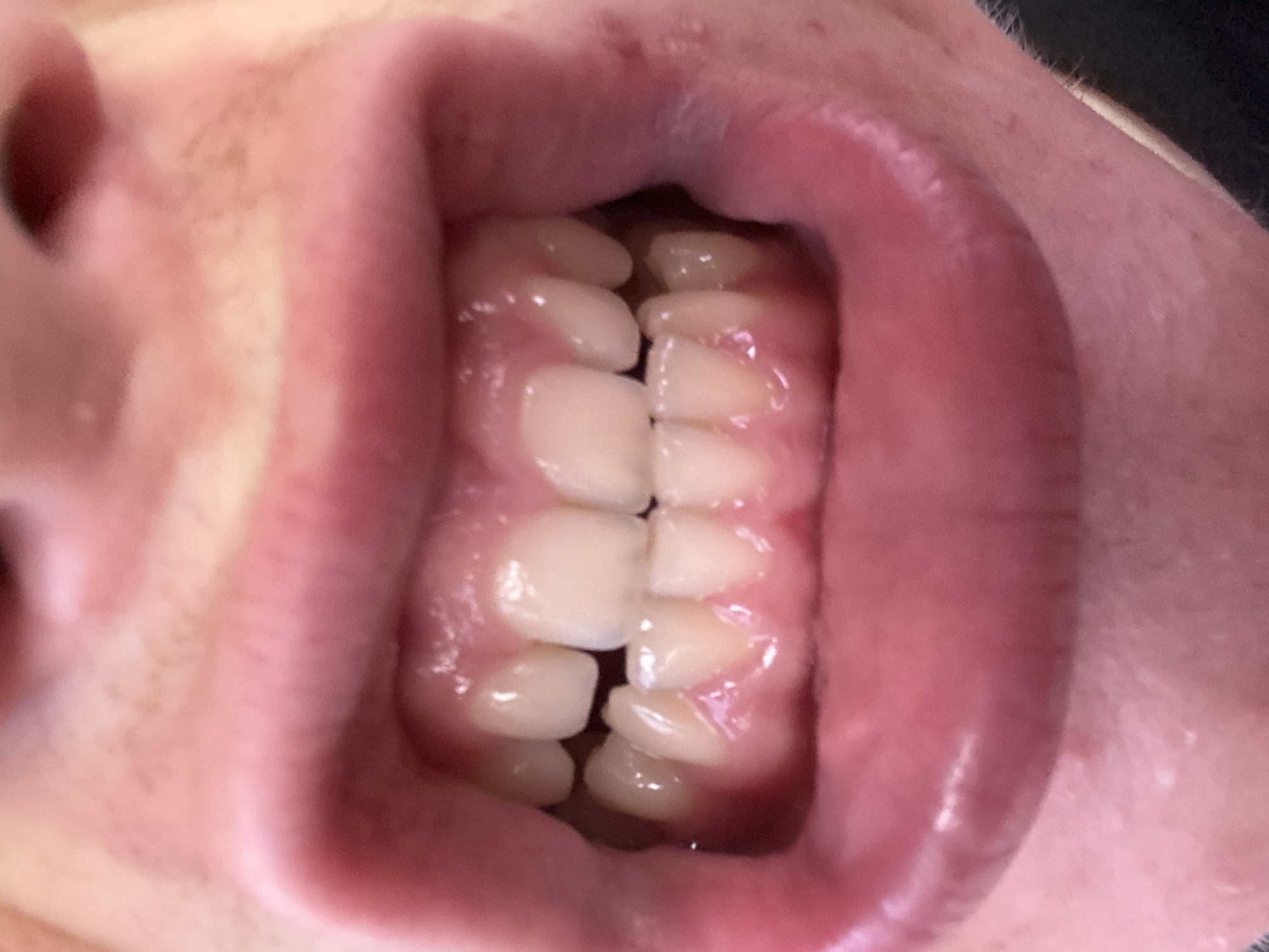 The image shows a close-up of a person's mouth with their teeth visible. The teeth are generally white and appear to be in good condition, though some slight crowding is noticeable in the front incisors. The gums are pink and healthy. The lips are slightly parted, revealing the teeth. The surrounding skin is fair. The image is a detailed, forensic-style close-up of the oral cavity, with no discernible urban or natural environment visible. Therefore, it is impossible to determine any location, including the city of Voronivka, Ukraine, or any environmental context.