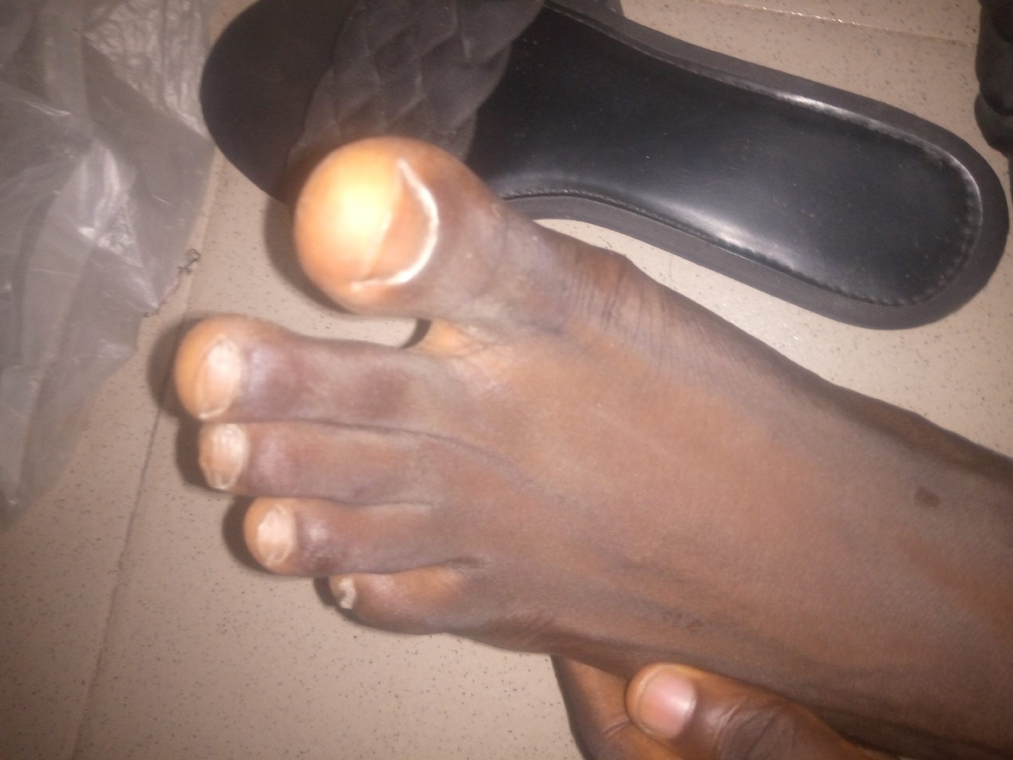 The image shows a close-up view of a person's left foot. The foot is dark-skinned and appears to be resting on a tiled surface. A black sandal with a textured strap is visible behind the foot. Part of a white plastic bag is also present in the background. The focus is on the toes and the sole of the foot.
