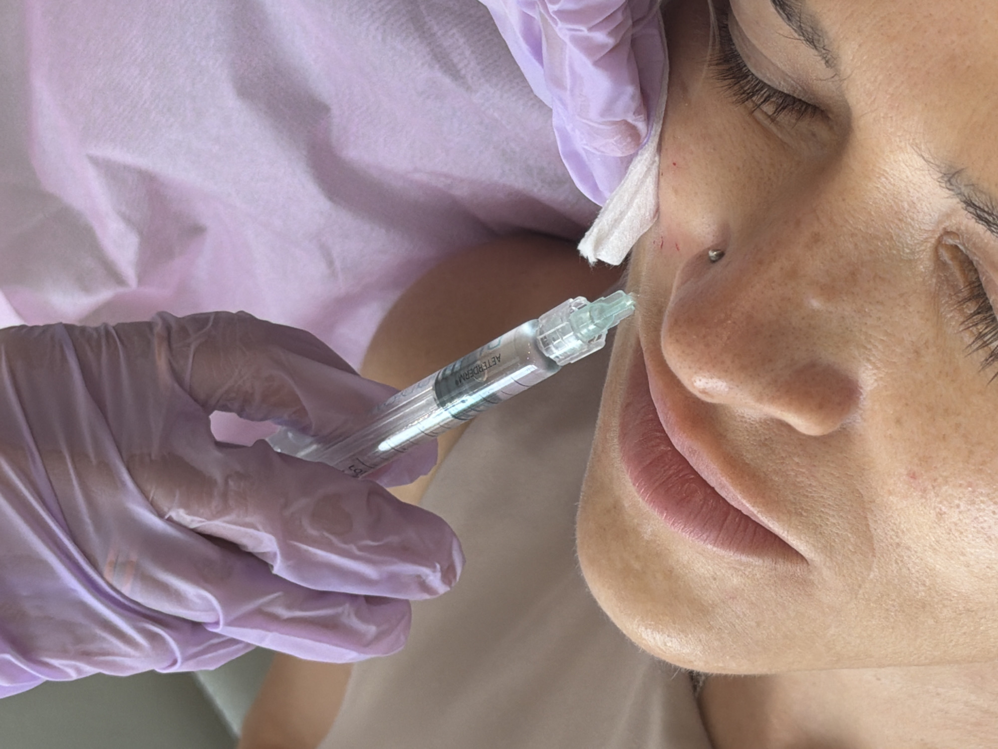 In a close-up, high-angle shot, a cosmetic procedure is being performed on the left side of a person's face. The subject's eyes are closed, and they have freckles on their cheek and a silver stud nose piercing. Their lips are a natural pink hue, and their skin appears well-hydrated.
A hand, covered in a light purple medical glove, holds a transparent pre-filled syringe containing a clear liquid, labeled "AETERDERM." The tip of the syringe is positioned near the subject's nasolabial fold area, suggesting an injection is taking place or has just occurred. A small piece of white gauze or cotton is held against the subject's temple area, possibly for cleaning or gentle pressure. Small red marks are visible on the skin, indicative of previous injection points or preparation.
The background consists of a textured, light purple medical drape or head covering, worn by the subject, creating a sterile and professional setting. The overall impression is that of a cosmetic dermatology or aesthetic clinic environment.