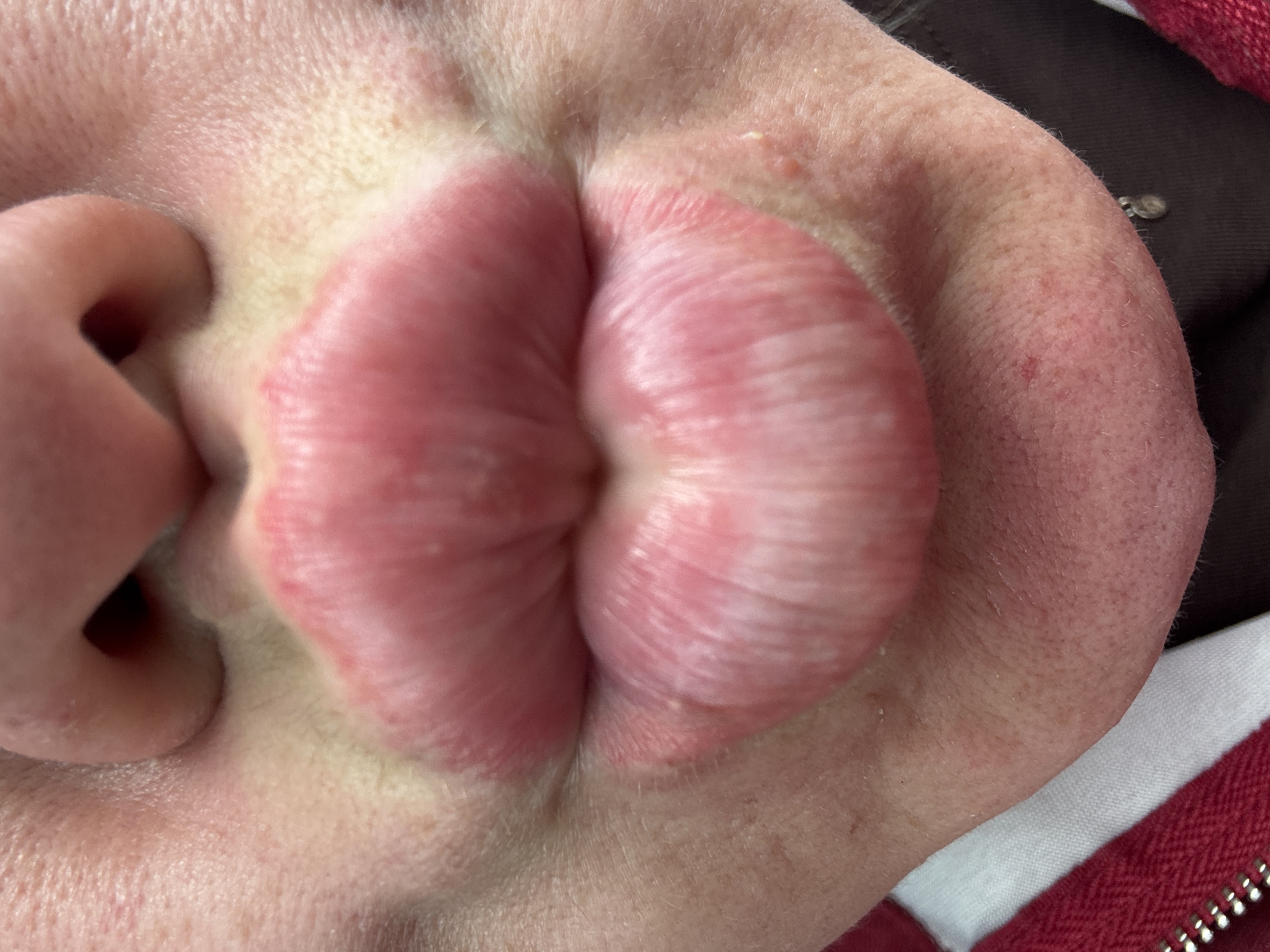 The image is a close-up, frontal view of a person's lips pursed in a kissing gesture. The lips are full and pink, with visible texture and some subtle lines. The skin around the mouth is fair with some minor blemishes and freckles. The lower portion of the image shows part of a red and white garment, possibly a jacket, with a zipper visible on the left. The background is dark and out of focus. The image provides no information about the location of Chastyye, Russia.