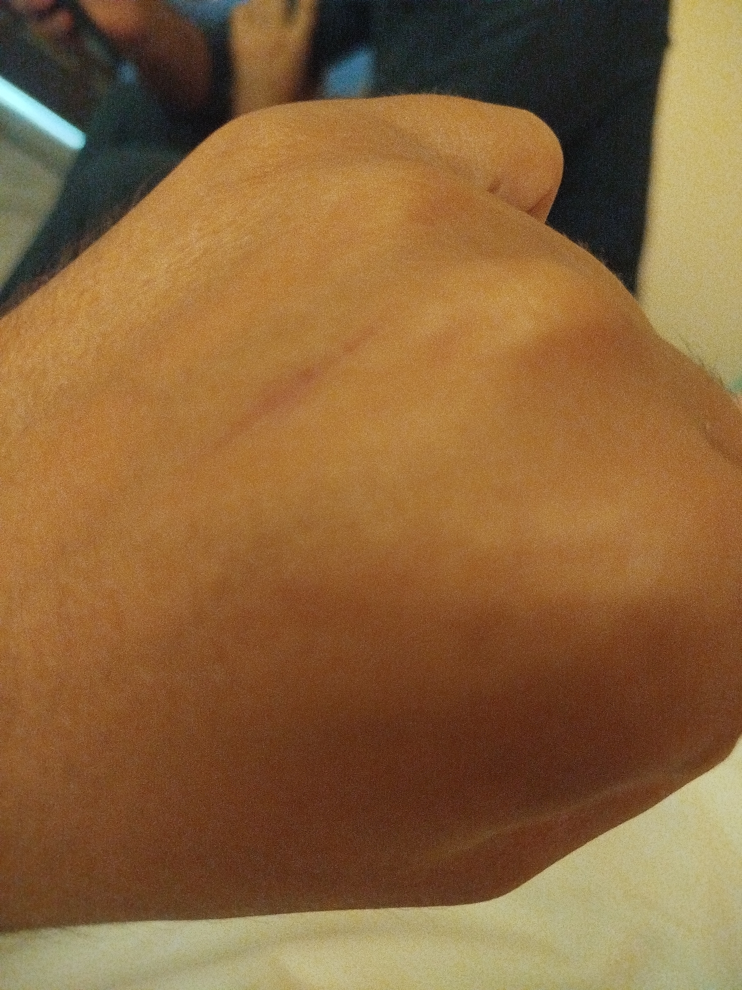 The image shows a close-up view of a person's hand. A small, faint scratch is visible on the skin. The background is out of focus and appears to be a dark fabric, possibly clothing. There are no discernible elements in the image that can be used to determine its location in Lassan, Pakistan.