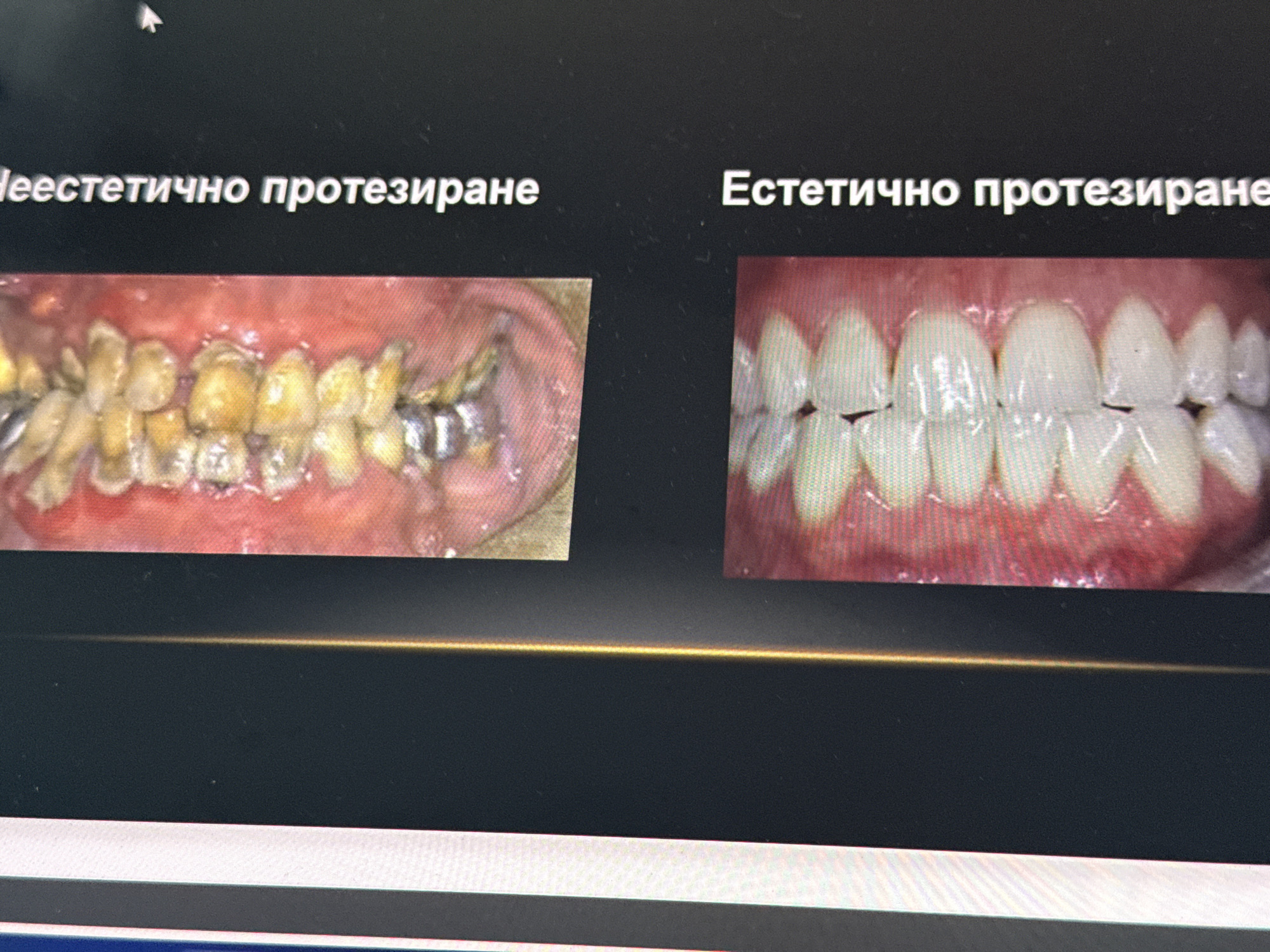The image displays a photograph of a digital screen presenting a "before and after" comparison of dental prosthetics. The scene is a dark background, likely a presentation slide or an application interface, with a white mouse cursor visible in the upper-left corner.
On the left side of the screen, an image titled "Неестетично протезиране" (Non-aesthetic prosthetics in Bulgarian) shows a set of human teeth and gums. The teeth appear severely discolored, yellowish-brown, and uneven, with visible signs of decay, wear, and significant plaque or calculus buildup. Several teeth have metallic dental work, possibly old fillings or crowns. The gums around these teeth appear red and inflamed.
On the right side, an image titled "Естетично протезиране" (Aesthetic prosthetics in Bulgarian) displays a set of healthy, uniformly white, and well-aligned prosthetic teeth. The gums are pink and appear healthy, contrasting sharply with the "before" image.
A prominent horizontal golden-yellow line spans across the middle-lower portion of the screen, potentially a divider or design element. Below this, a white and gray bar indicates the bottom edge of an application window or interface. The visible text is in Bulgarian, supporting the provided location context of Varna, Bulgaria. The image captures a clear visual demonstration of dental transformation from poor oral health and non-aesthetic dental work to a clean, aesthetically pleasing result.