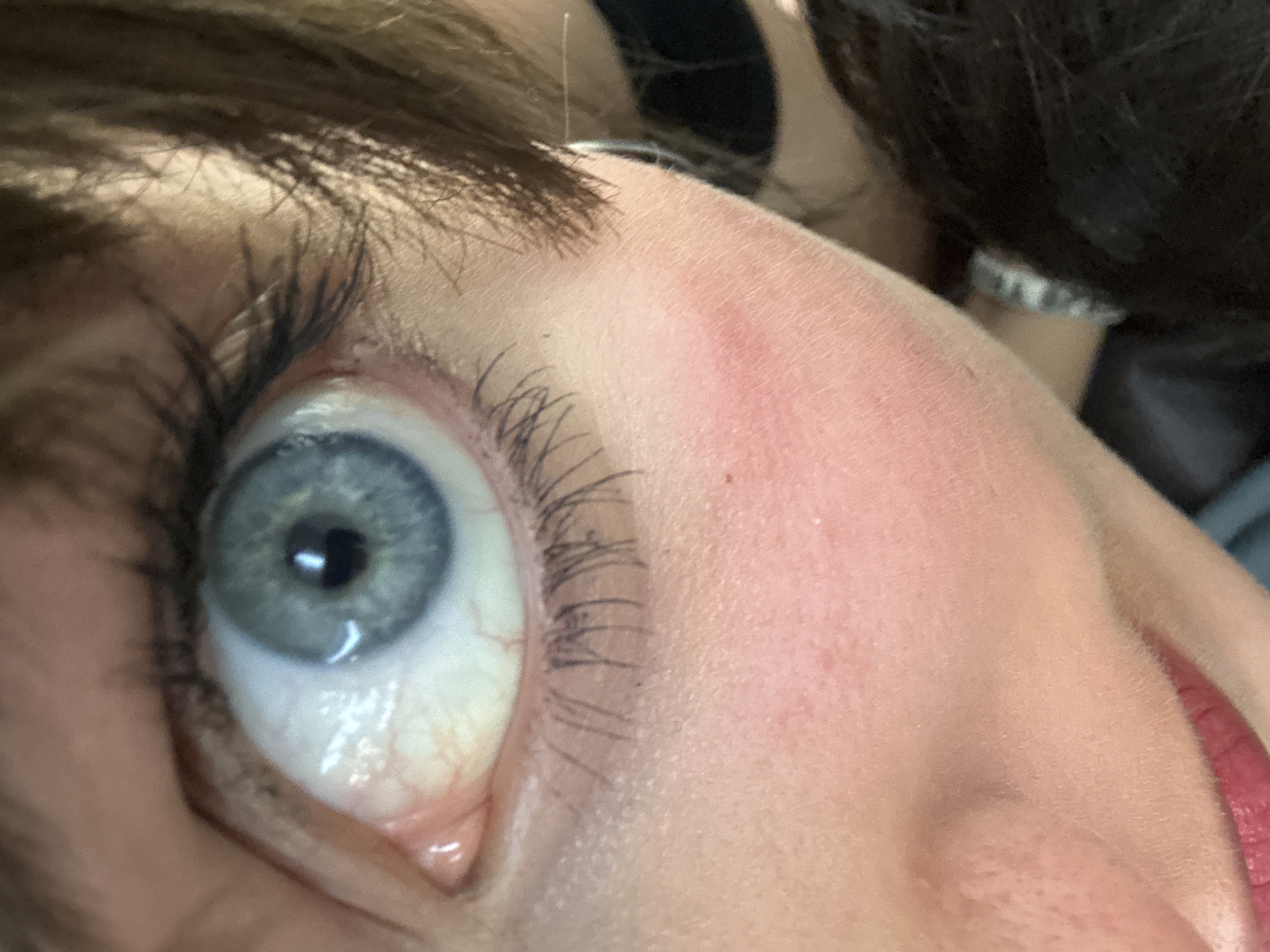 Close-up of a person's left eye. The eye has a light blue iris and appears watery. Skin around the eye is fair. Eyelashes are dark. A section of brown hair is visible above the eye. Redness is observed on the face near the eye. A strand of hair is visible near the brow. The location of Huixquilucan de Degollado, Mexico, is not discernible from the image.