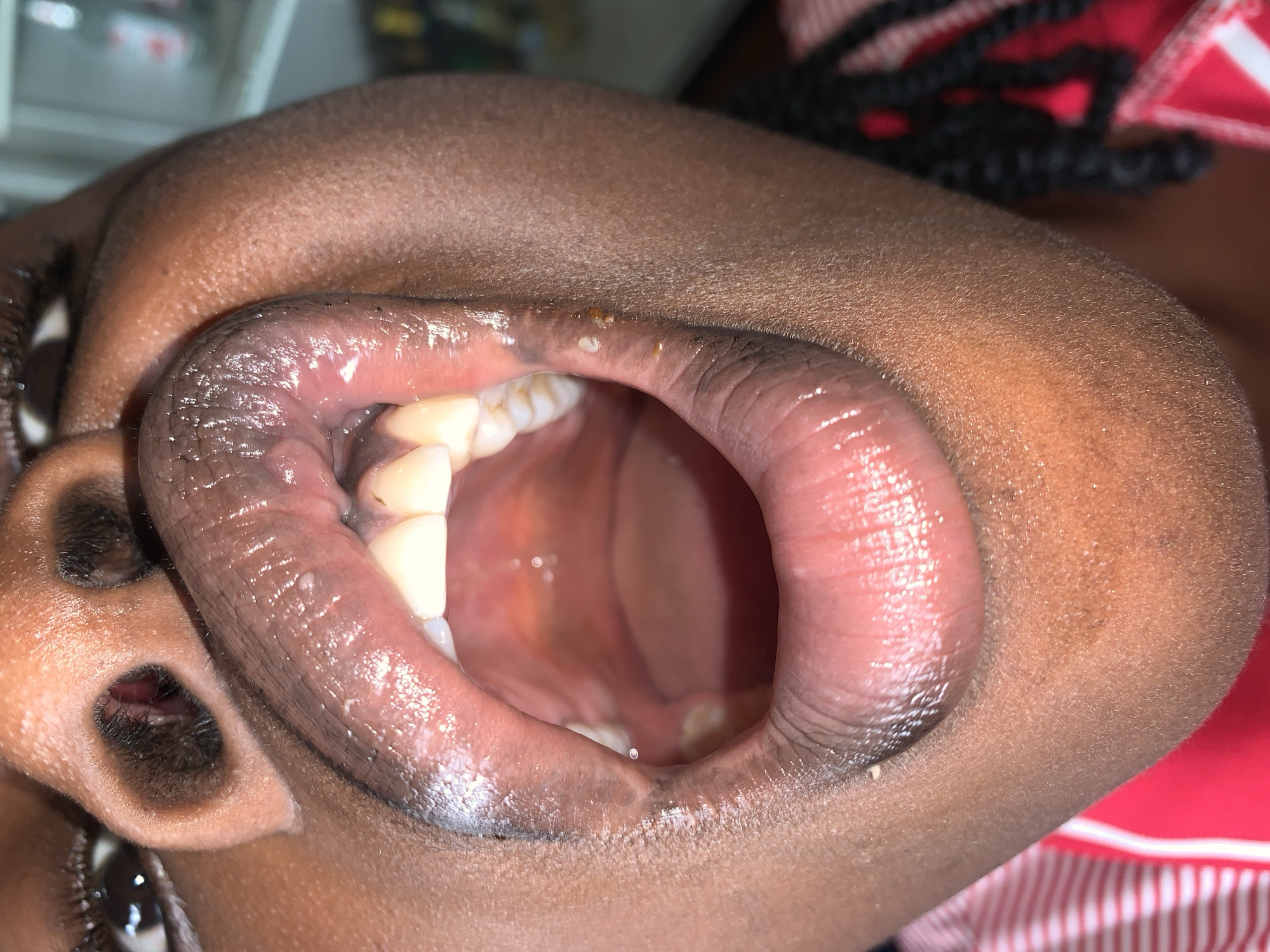 This close-up image features a person, likely of African descent given the dark skin tone, with their mouth open. The focus is on the oral cavity, lips, and surrounding facial skin.
The subject's lips are prominent, appearing moist and slightly textured. On the upper lip, particularly along the vermilion border and adjacent skin, there are several small, light-colored, irregular formations or lesions. These appear to be either dried secretions, small papules, or minor skin irregularities. The visible teeth are white and appear healthy. The gums and inner lining of the mouth (buccal mucosa) are also visible, appearing healthy. The back of the throat and palate can be seen in the open oral cavity.
Parts of the subject's face are visible, including a dark brown eye and portions of the nose and cheek, which exhibit fine hair texture typical of skin. The overall setting appears to be indoors, possibly for a medical examination or a portrait. In the blurred background, a red and white striped pattern is discernible, possibly from clothing or fabric. There is no discernible text in the image. This scene takes place in New Stadium, Nigeria.