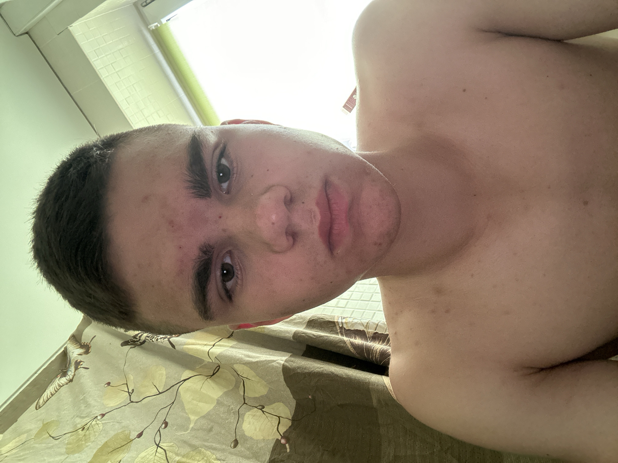 A young person with short, dark hair and fair skin is looking directly at the camera. They have dark eyebrows and dark eyes, and their face appears slightly flushed, with some red blemishes on their forehead and cheeks. They are not wearing a shirt, and their bare shoulders and upper chest are visible. The background shows a shower curtain with a pattern of leaves and butterflies. To the right of the person, a bright window with a light-colored blind is visible. The overall setting appears to be a bathroom. The image is a close-up shot, focusing on the person's face and upper body.