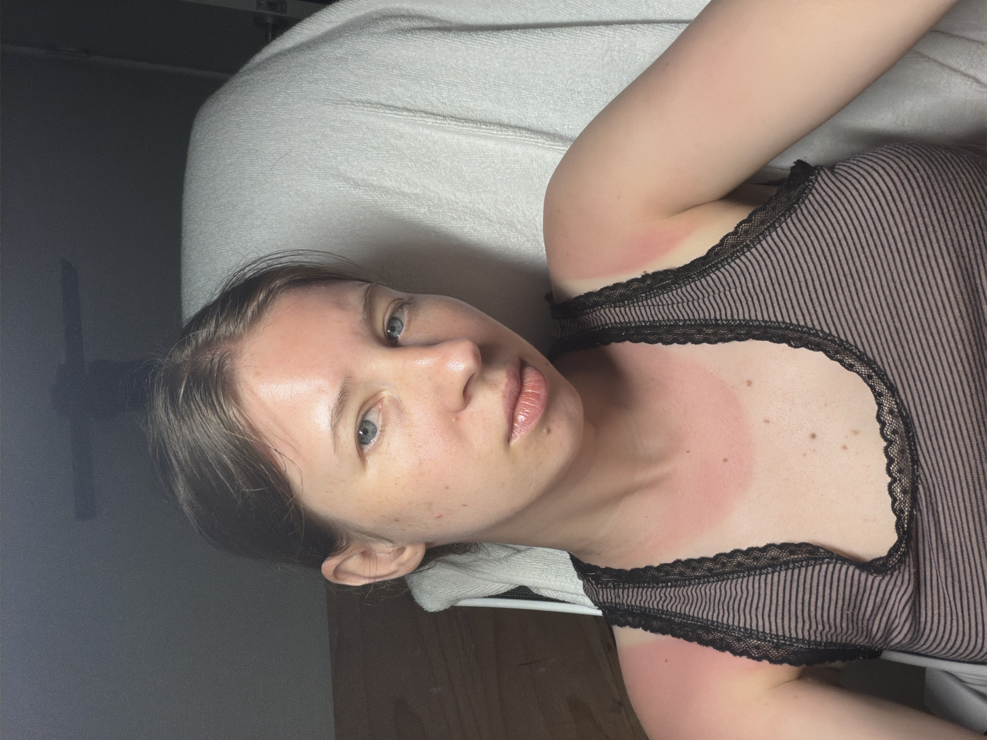 The image is a close-up, head-and-shoulders portrait of a young Caucasian woman with light skin, brown hair pulled back, and blue eyes. She is looking directly at the camera with a neutral expression. Her face is partially illuminated by a light source coming from the left, creating a shadow on the right side of her face. She has freckles on her nose and cheeks. Her skin appears flushed and red on her upper chest, shoulders, and upper arms, indicating sunburn. She is wearing a black and grey striped tank top with black lace trim. The background is dimly lit and appears to be an indoor setting, with a white towel draped over what looks like a chair or sofa behind her. To the left of the frame, a wooden surface is visible. The overall lighting is dim, with the primary light source highlighting the woman's face and shoulders. There is no identifiable geographical information within the image to suggest a specific location in Dongducheon-si, South Korea.