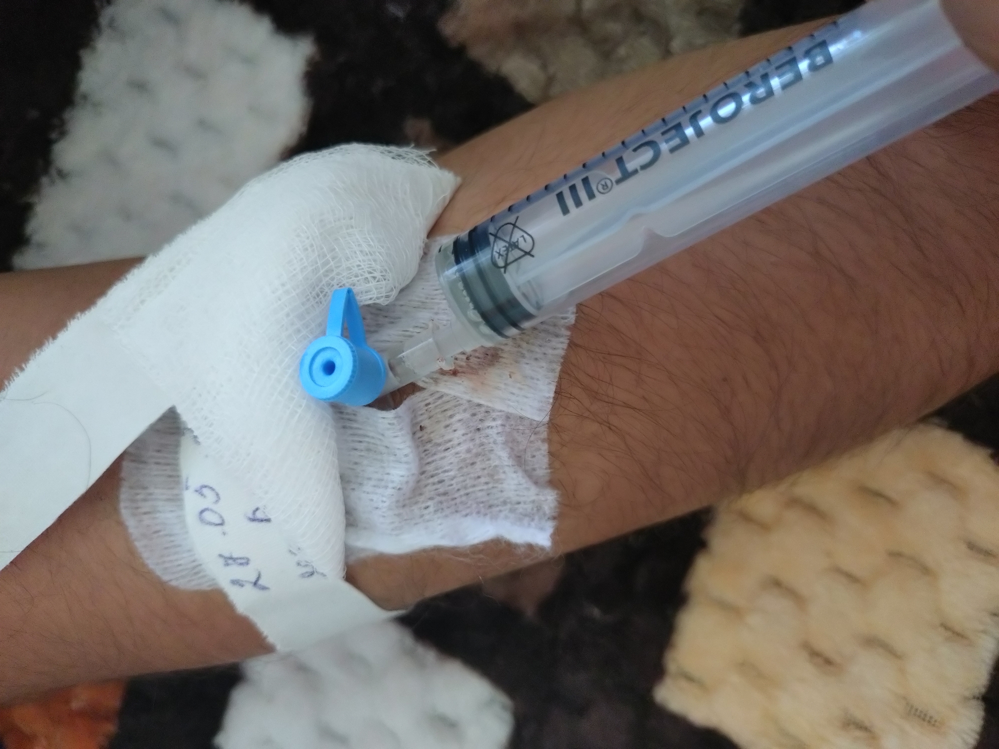 A close-up photograph depicts a person's forearm with an intravenous catheter inserted. The catheter site is covered with a white gauze bandage, secured with tape on which the date "28.03" is written. A clear plastic syringe is connected to the catheter. The arm is lightly hairy. The background includes a brown and beige patterned surface.
There is no information in the image to indicate its location in Stara Zagora, Bulgaria.