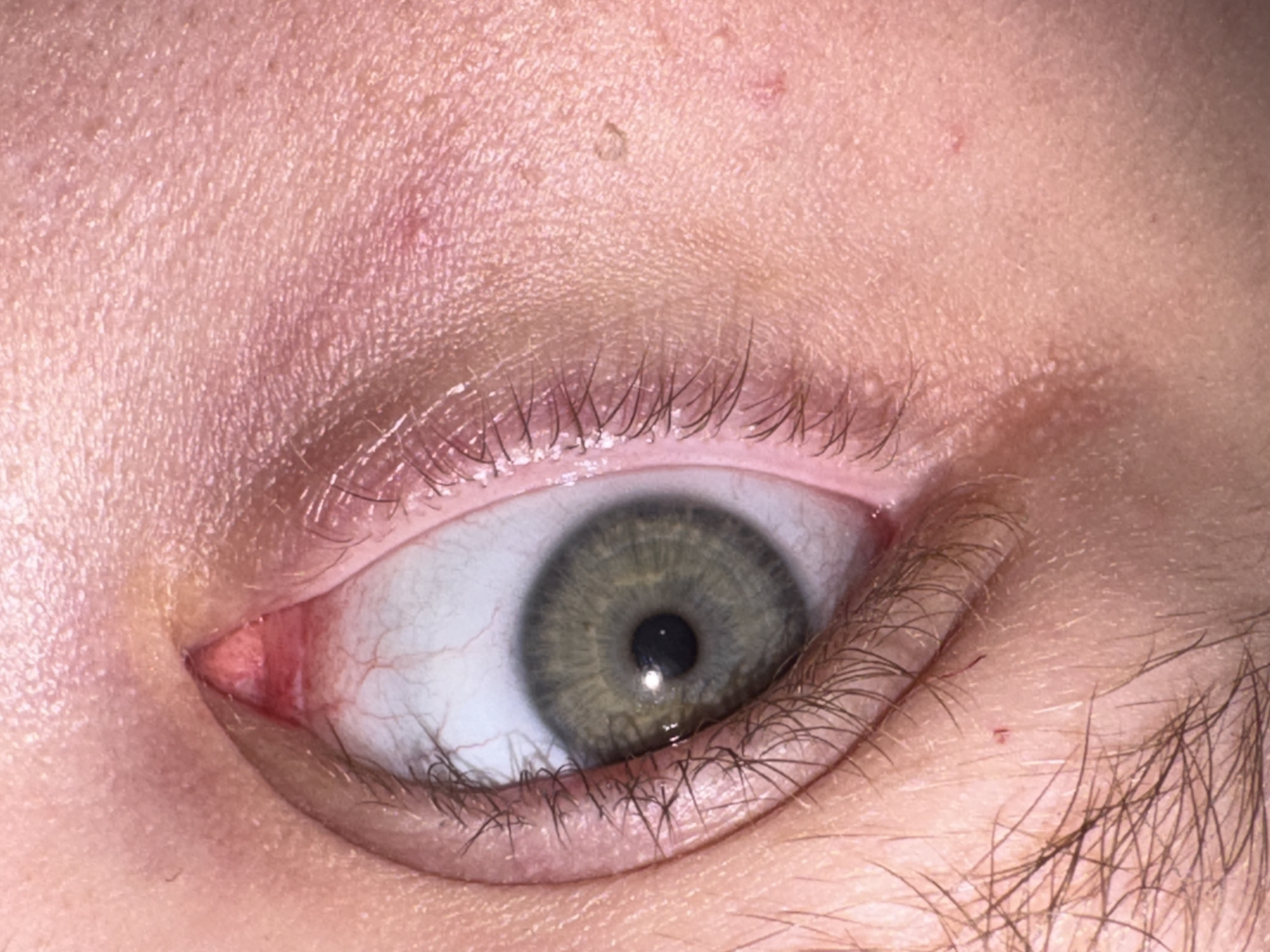 This is a close-up, forensic photograph of a human eye, showing the iris, pupil, sclera, eyelashes, and surrounding skin. The iris is a muted green-gray color with visible striations. The sclera exhibits some redness and visible blood vessels, particularly in the inner corner of the eye. The eyelashes are dark and appear somewhat sparse. The skin surrounding the eye shows texture, pores, and a few small, reddish blemishes or marks. The lighting appears to be direct, creating some specular highlights on the surface of the eye. The image is focused on the eye and its immediate surroundings, with no other environmental details visible.