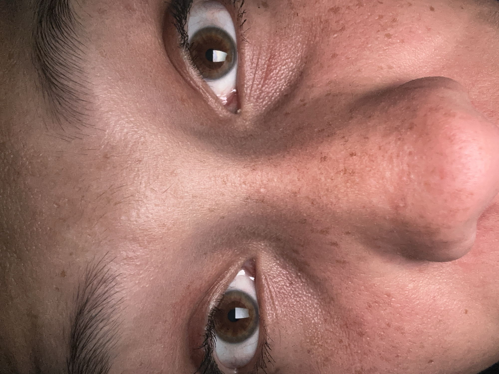 This close-up portrait captures the upper part of a human face, rotated 90 degrees clockwise, showcasing the eyes, eyebrows, and bridge of the nose. The subject has a light to medium skin tone with prominent pores and a scattering of numerous small, dark brown freckles across the cheeks, under-eye area, and nose. There are areas of slight redness and uneven texture on the skin.
Both eyes feature deep brown irises and large, dilated pupils. Within each pupil, distinct rectangular reflections are visible, suggesting an indoor setting with artificial light sources or windows. The eyelashes are dark and well-defined, and the eyebrows are full with dark, fine hairs. The whites of the eyes appear bright. The bridge of the nose is centered and shows subtle shadows and a hint of redness.
The person's gaze is direct and intense, with wide-open eyes, which could convey a sense of alertness, surprise, or focused attention. No specific activity or event beyond the act of looking is depicted. There are no additional objects or visible text within the frame. The image emphasizes the intricate details of the facial features and skin. While the context places the image in Sofia, Bulgaria, there are no visual cues in the photograph itself to indicate this location.