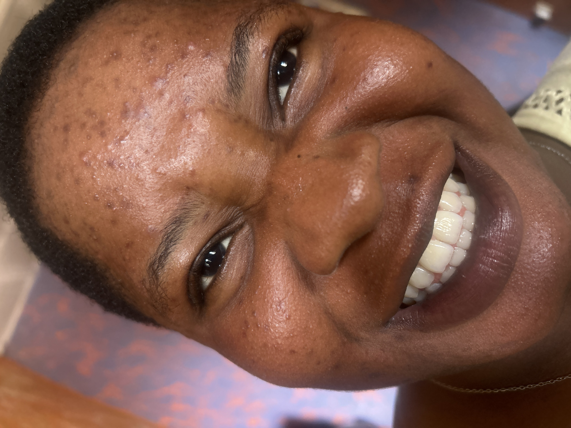 A close-up, angled portrait of a dark-skinned person with short, dark hair. The person is smiling, revealing white teeth. The subject's skin appears to have texture, with some visible blemishes and pores. The background is blurred and indistinct, appearing to show a light blue and orange surface. The person wears a thin, gold chain around their neck. The location and city are unknown.