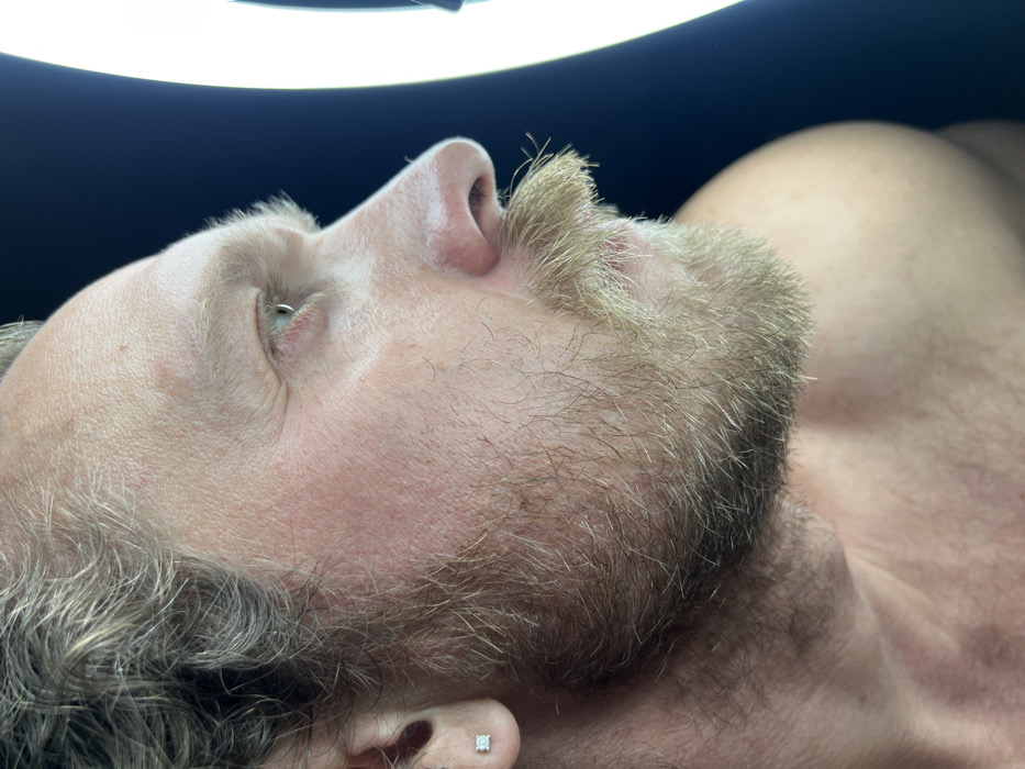 The image presents a close-up, side profile of a person, likely male, lying down with their head turned to the left and gaze directed upwards. The person has fair skin, a prominent nose, and a thick, light blonde to brownish beard and mustache. The beard extends across the jawline and down the neck, and his hair, visible on the side of his head, appears to be a mix of blonde and grey, suggesting a mature individual.
A distinctive feature is a small, metallic piercing, possibly a hoop or captive bead ring, visible in the corner of the right eye, near the tear duct or upper eyelid crease. The eye itself appears mostly closed or looking away from the camera. In the visible earlobe, there is a small, square-shaped earring, possibly a diamond or crystal stud.
The upper part of a bare shoulder and chest are visible in the background, suggesting the person is shirtless. Some light body hair is present on the chest.
The background directly above the person's head is dark, almost black. A bright, elongated light source, resembling a bar light or a strip of LED lights, casts a strong, uniform illumination from above, indicating an indoor setting, possibly a studio, a clinic, or a salon where detailed work might be performed on the face or head. The overall impression is one of a person resting or undergoing a procedure under specific lighting conditions. There is no visible text in the image.